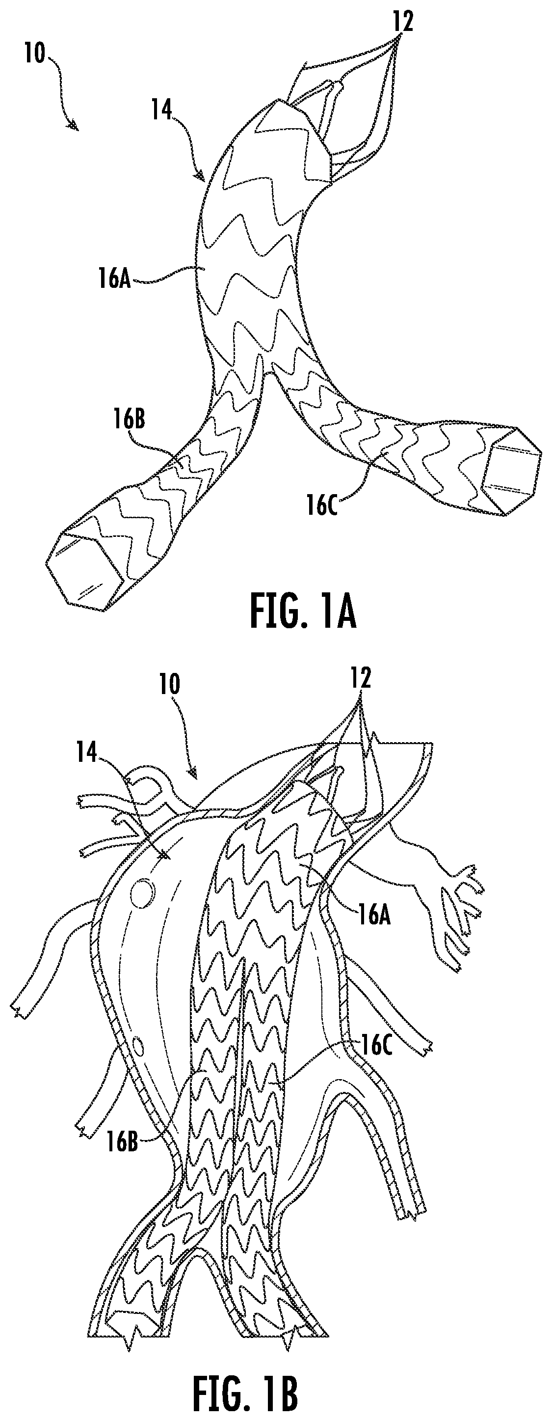Patent US12396871 Figure 1 – Devices and methods for stent graft extraction