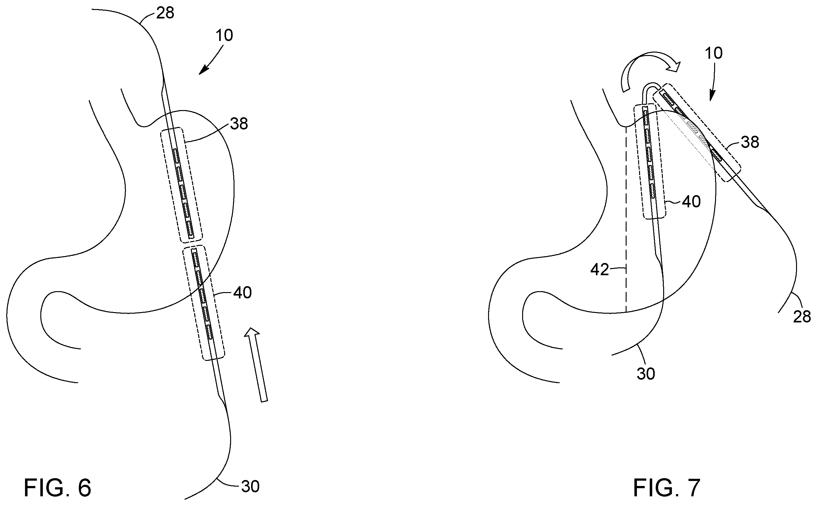 Patent US12396874 Figure 5 – Magnetic devices for digestive tract partitioning