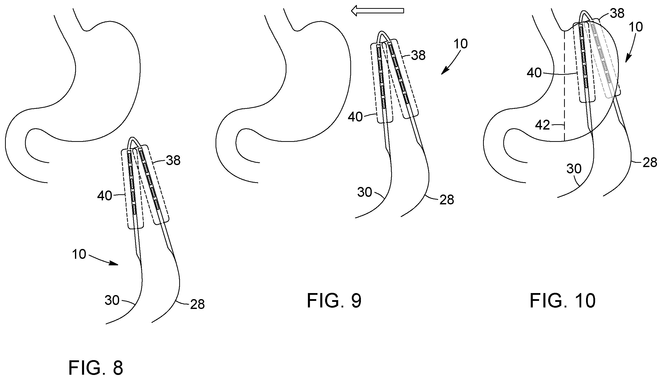 Patent US12396874 Figure 6 – Magnetic devices for digestive tract partitioning