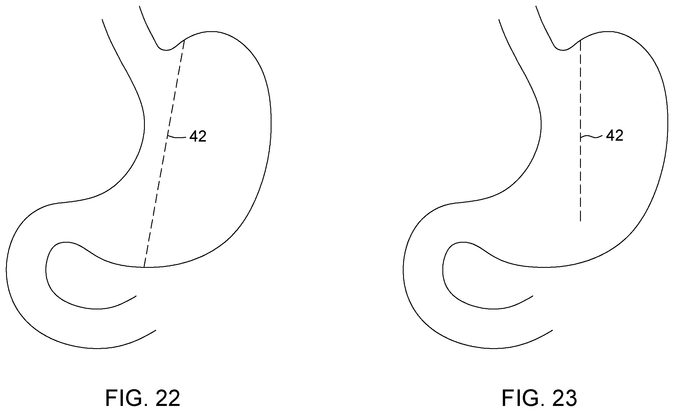 Patent US12396874 Figure 14 – Magnetic devices for digestive tract partitioning