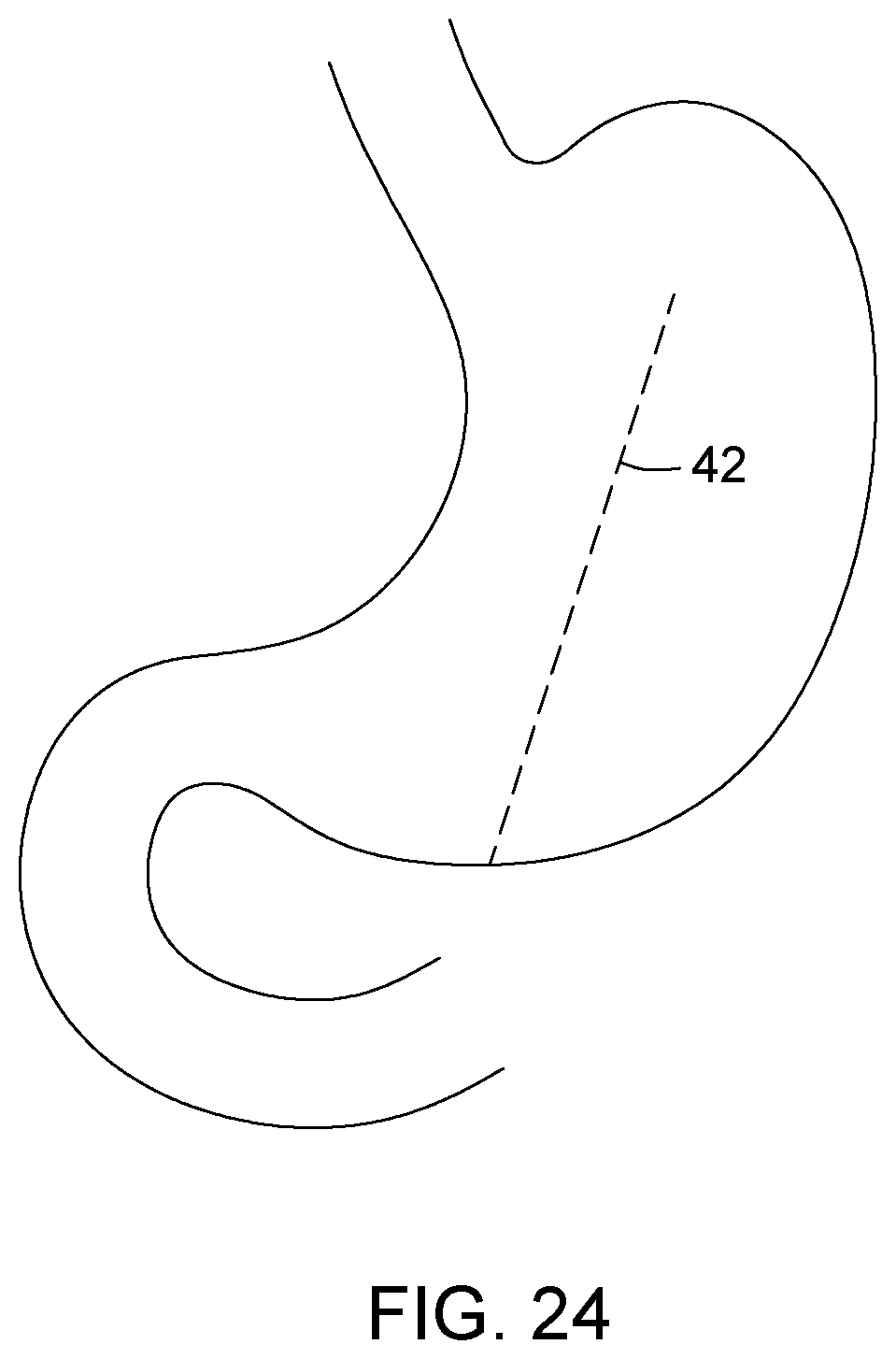 Patent US12396874 Figure 15 – Magnetic devices for digestive tract partitioning
