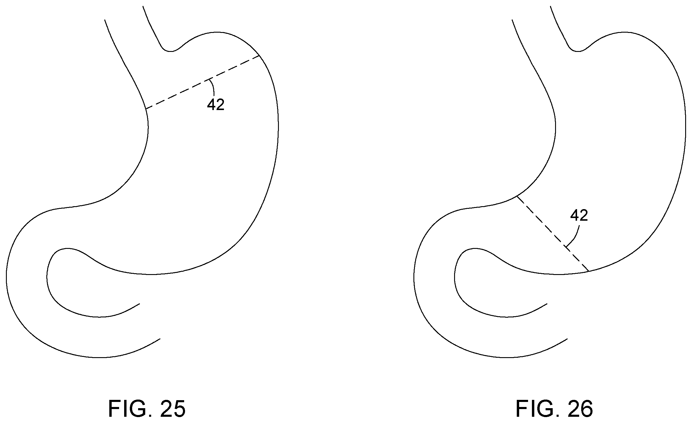 Patent US12396874 Figure 16 – Magnetic devices for digestive tract partitioning