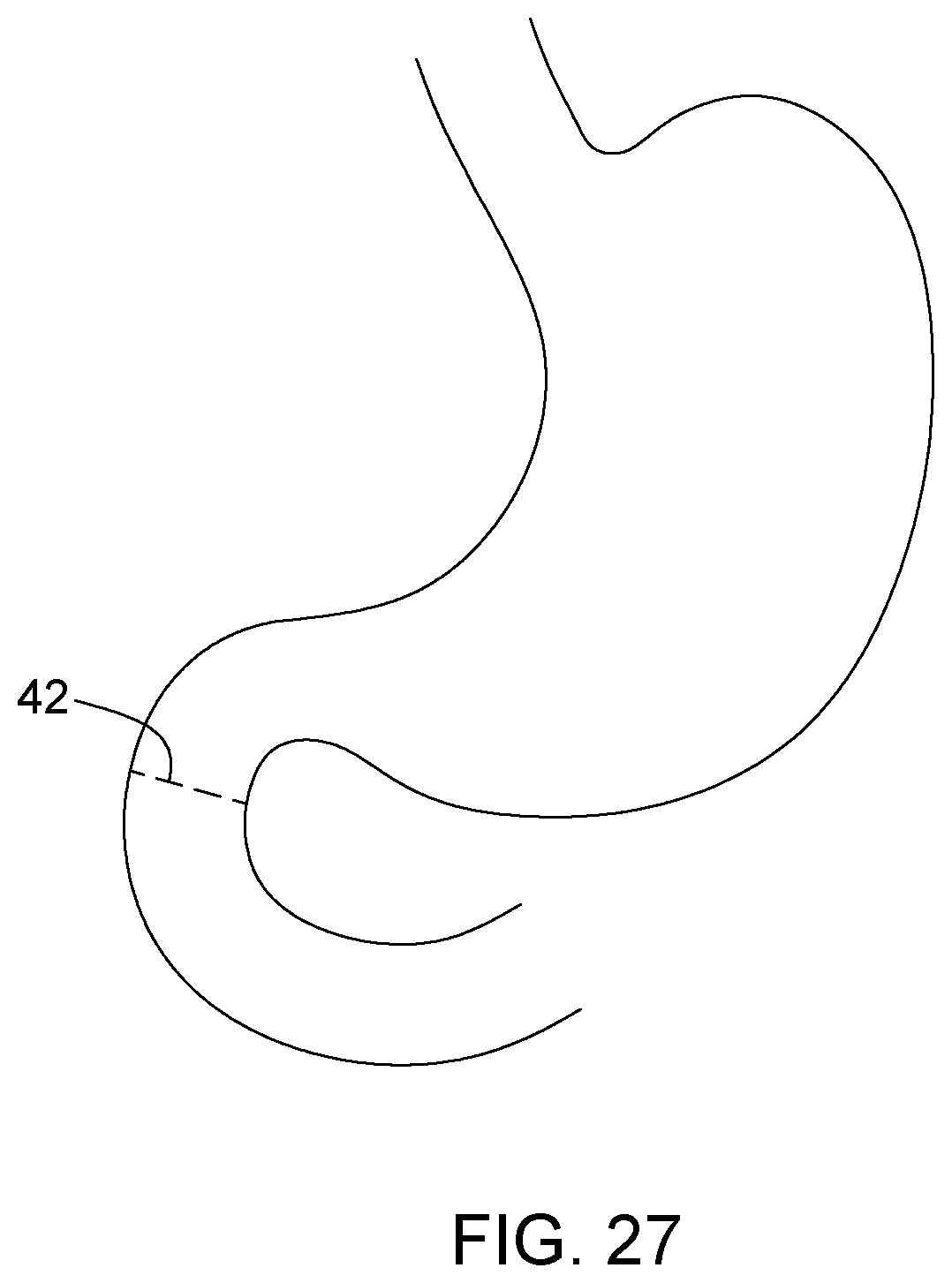 Patent US12396874 Figure 17 – Magnetic devices for digestive tract partitioning