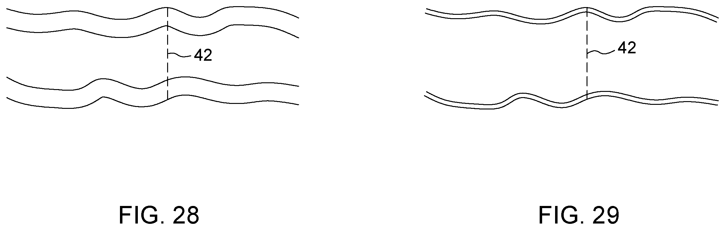 Patent US12396874 Figure 18 – Magnetic devices for digestive tract partitioning