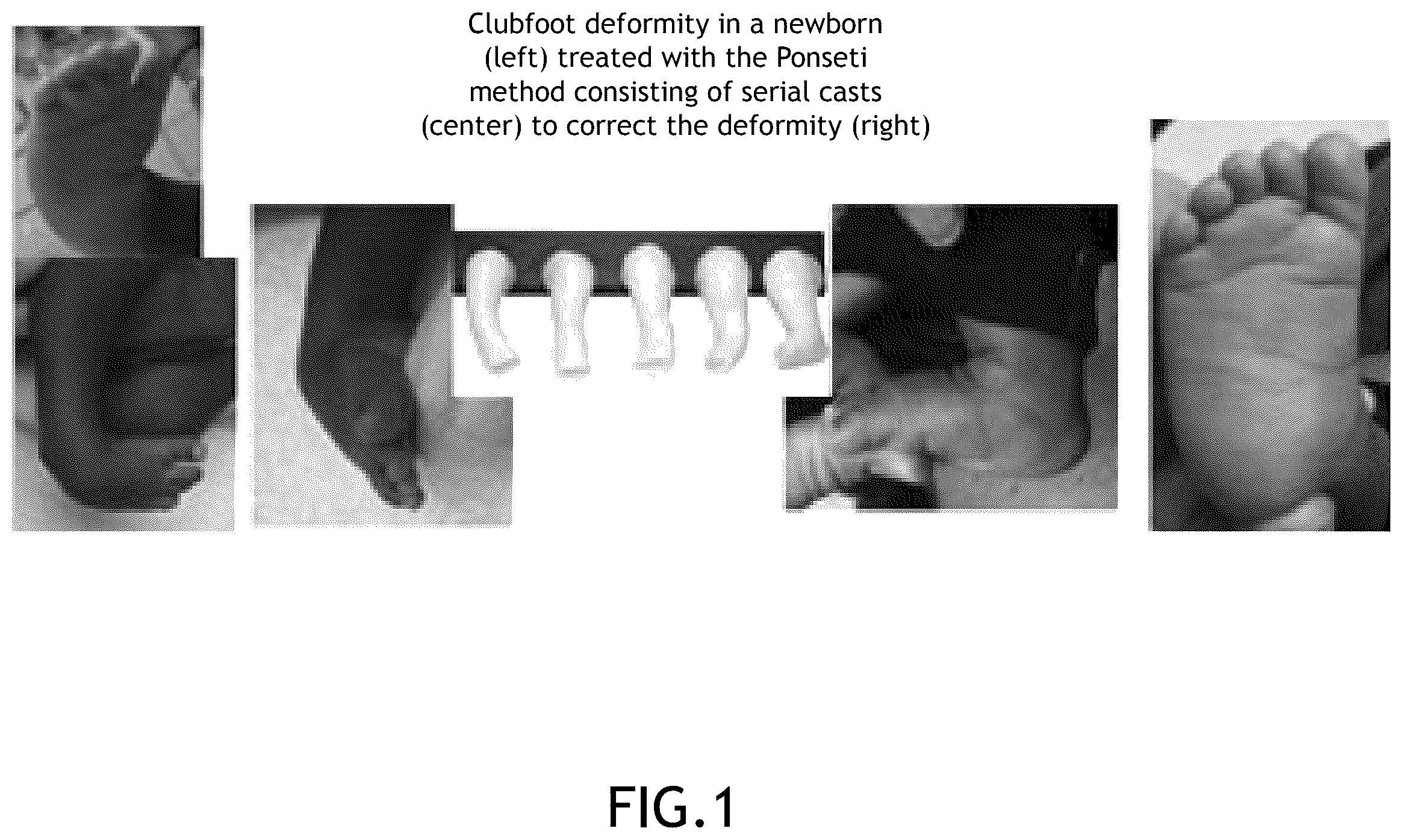 Patent US12396878 Figure 1 – Smart corrective alignment foot brace