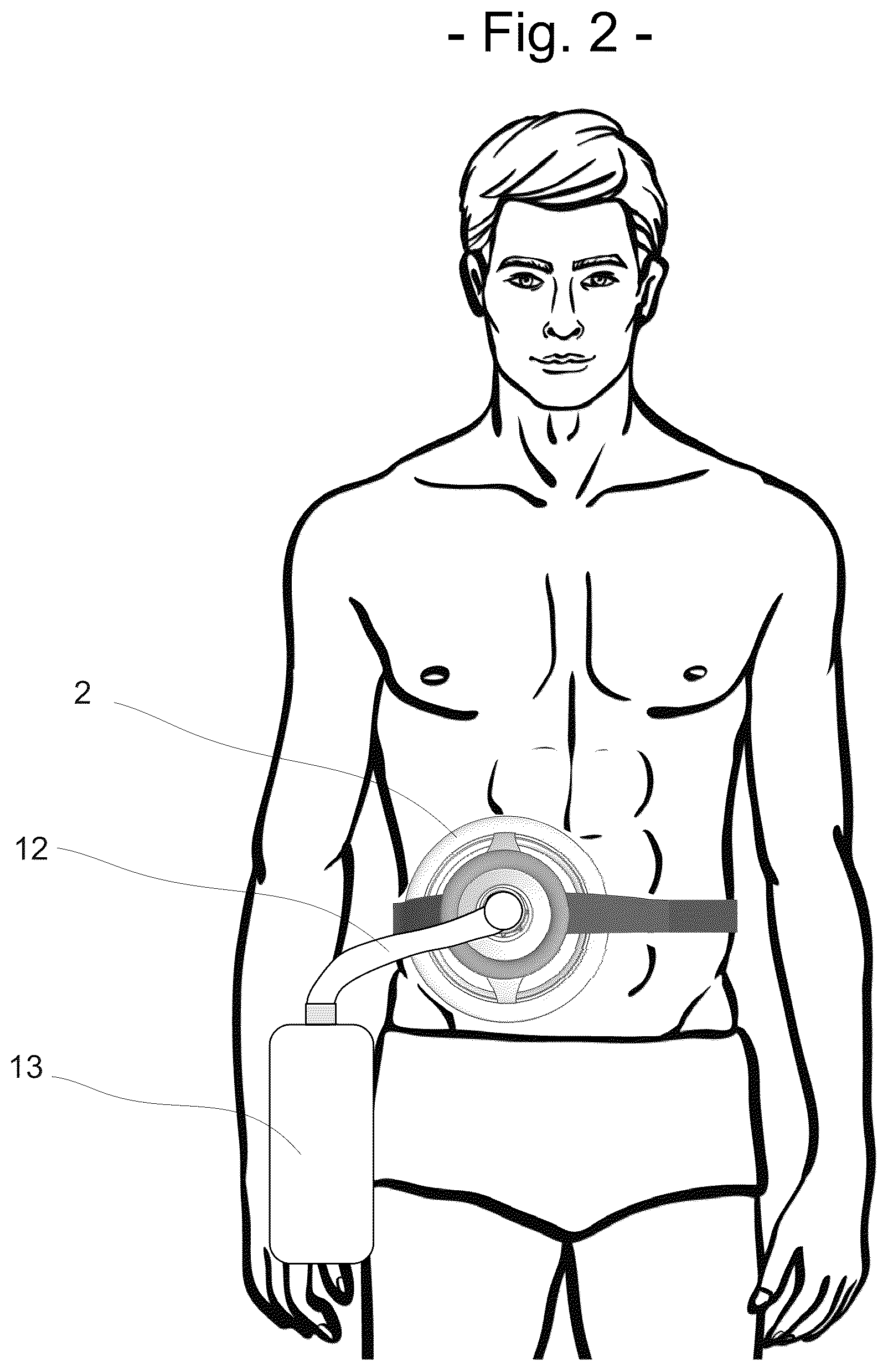 Patent US12396880 Figure 2 – Ostomy output diversion device