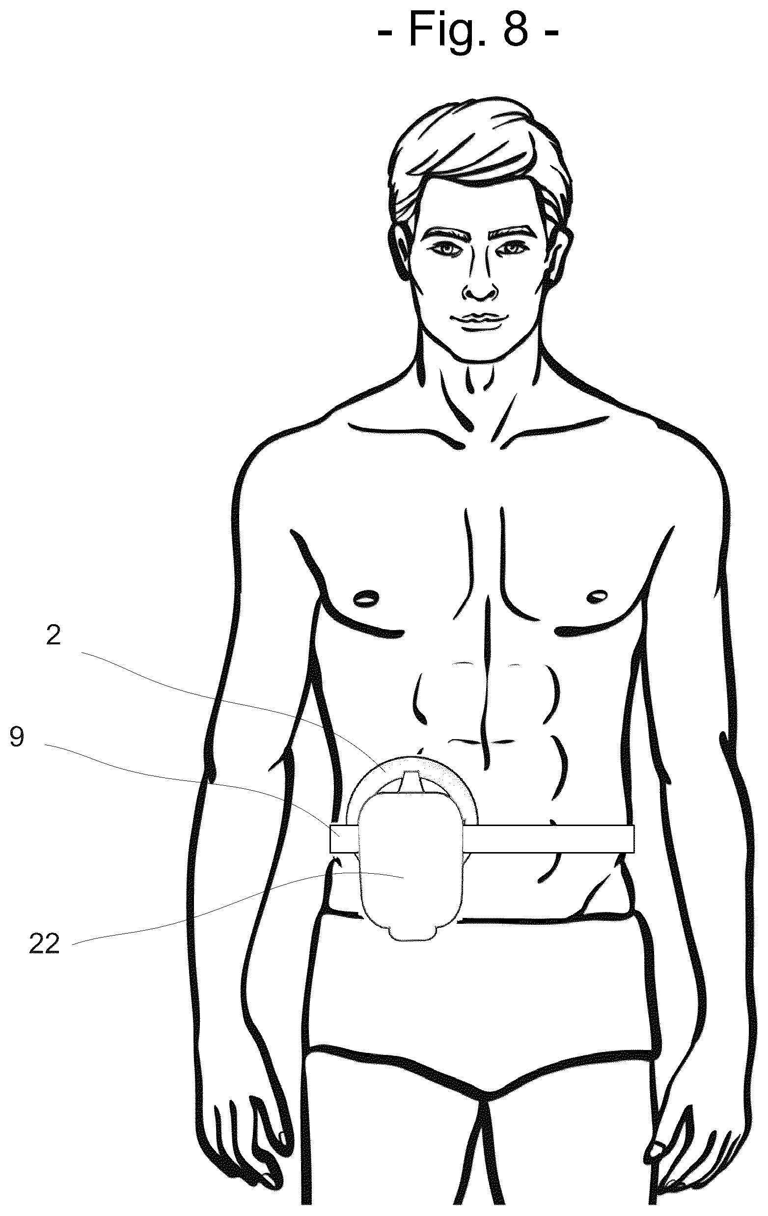 Patent US12396880 Figure 8 – Ostomy output diversion device