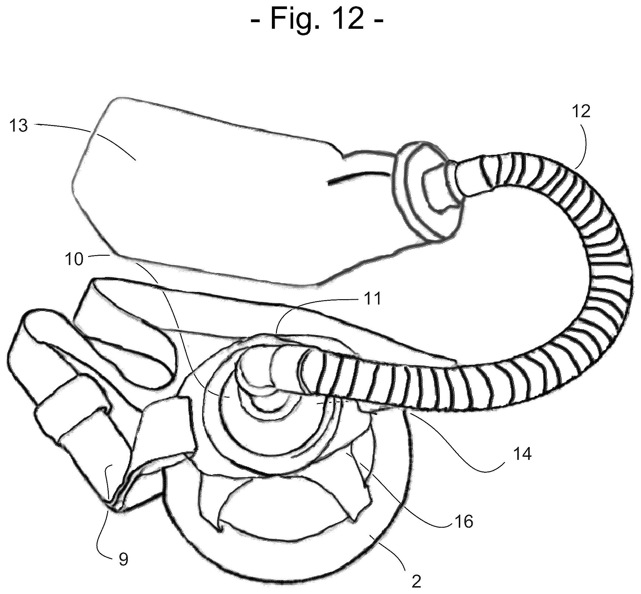 Patent US12396880 Figure 12 – Ostomy output diversion device