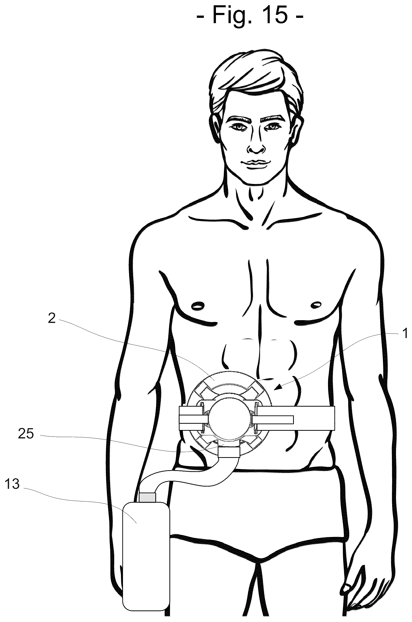 Patent US12396880 Figure 15 – Ostomy output diversion device
