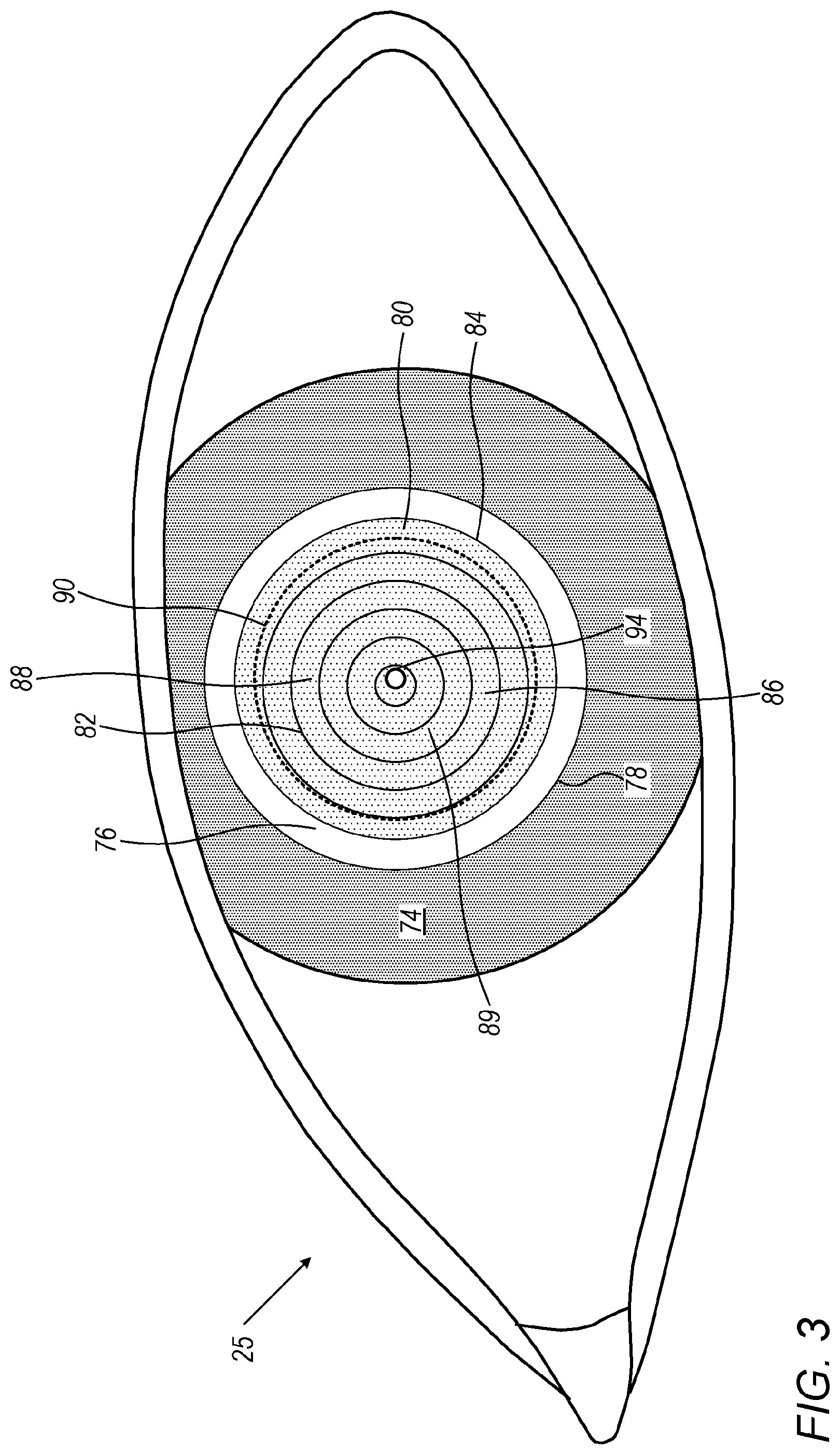 Patent US12396886 Figure 3 – Automated capsulotomy