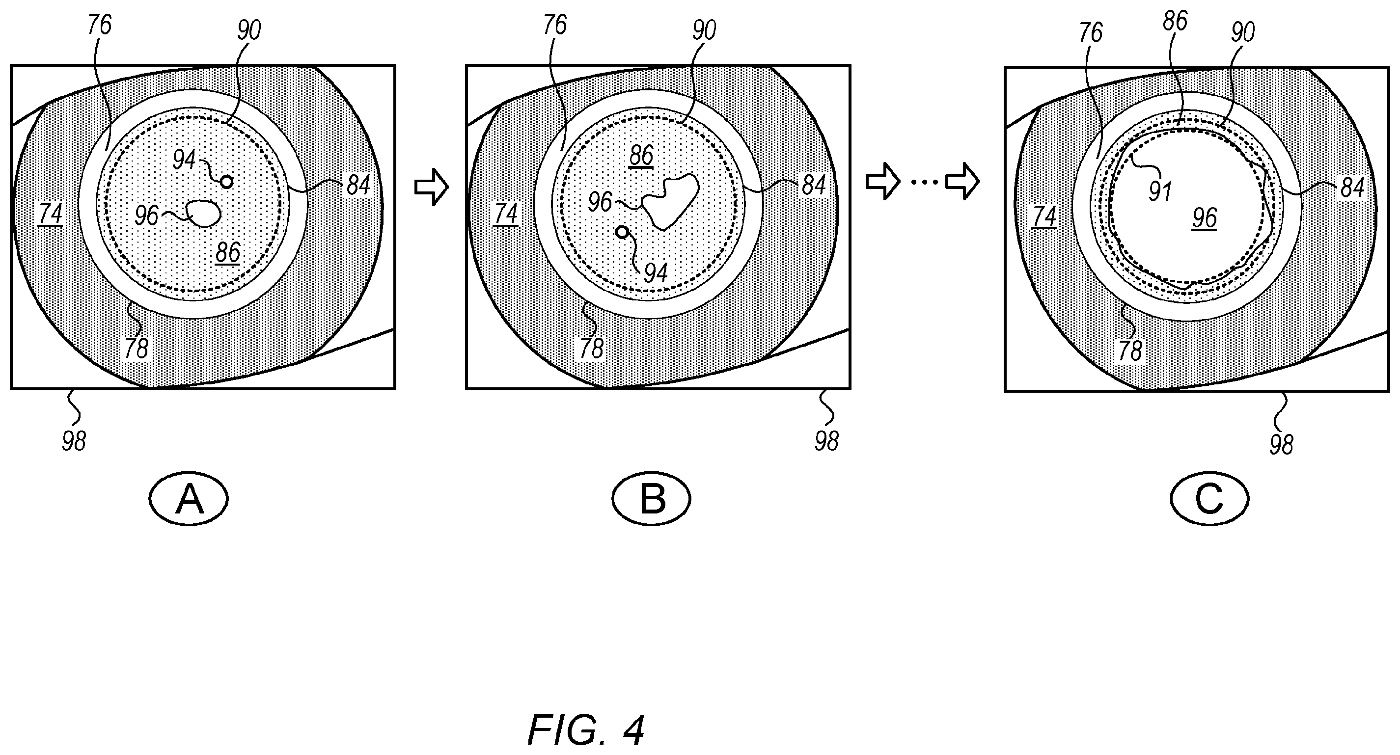 Patent US12396886 Figure 4 – Automated capsulotomy