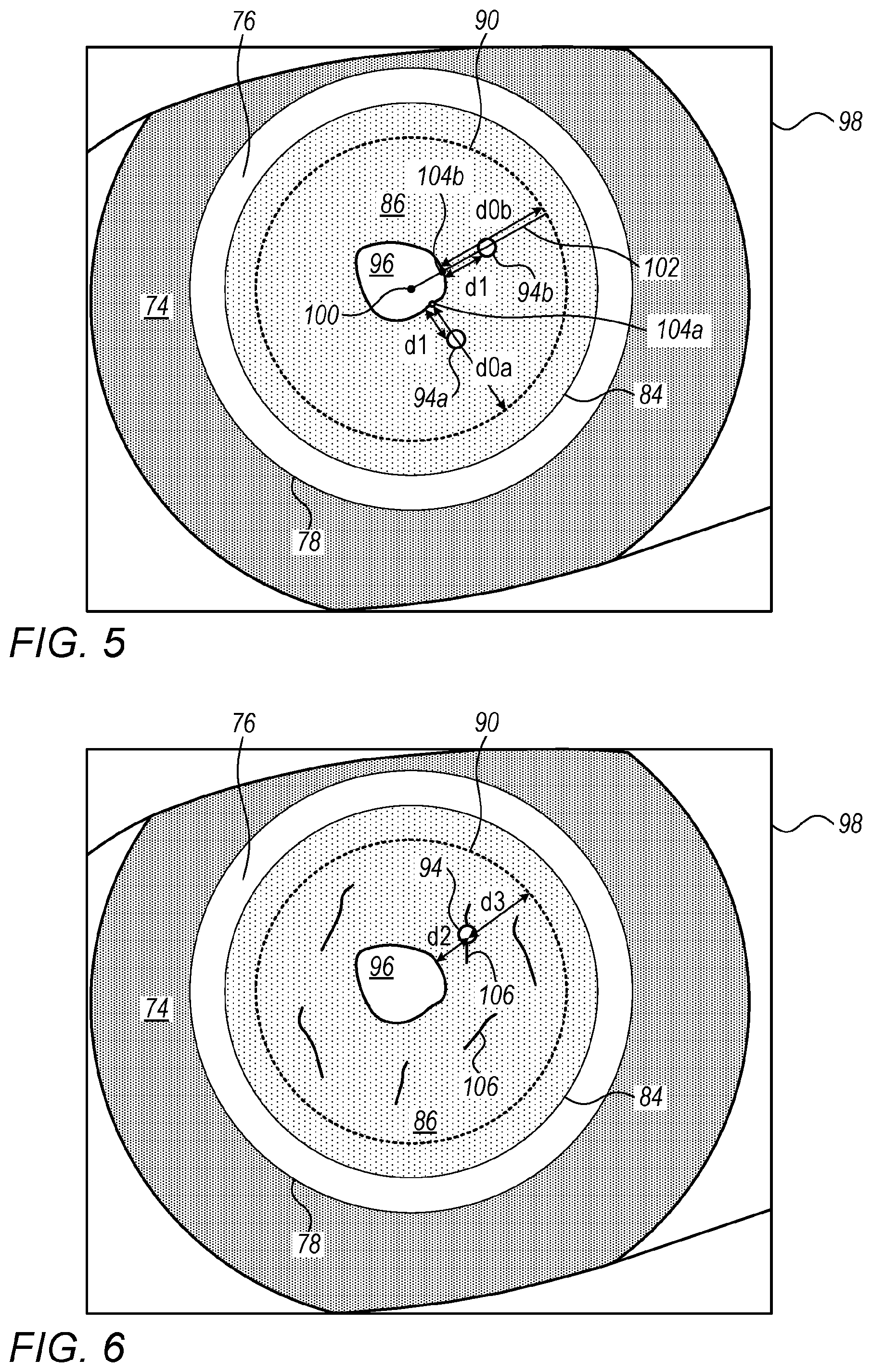 Patent US12396886 Figure 5 – Automated capsulotomy