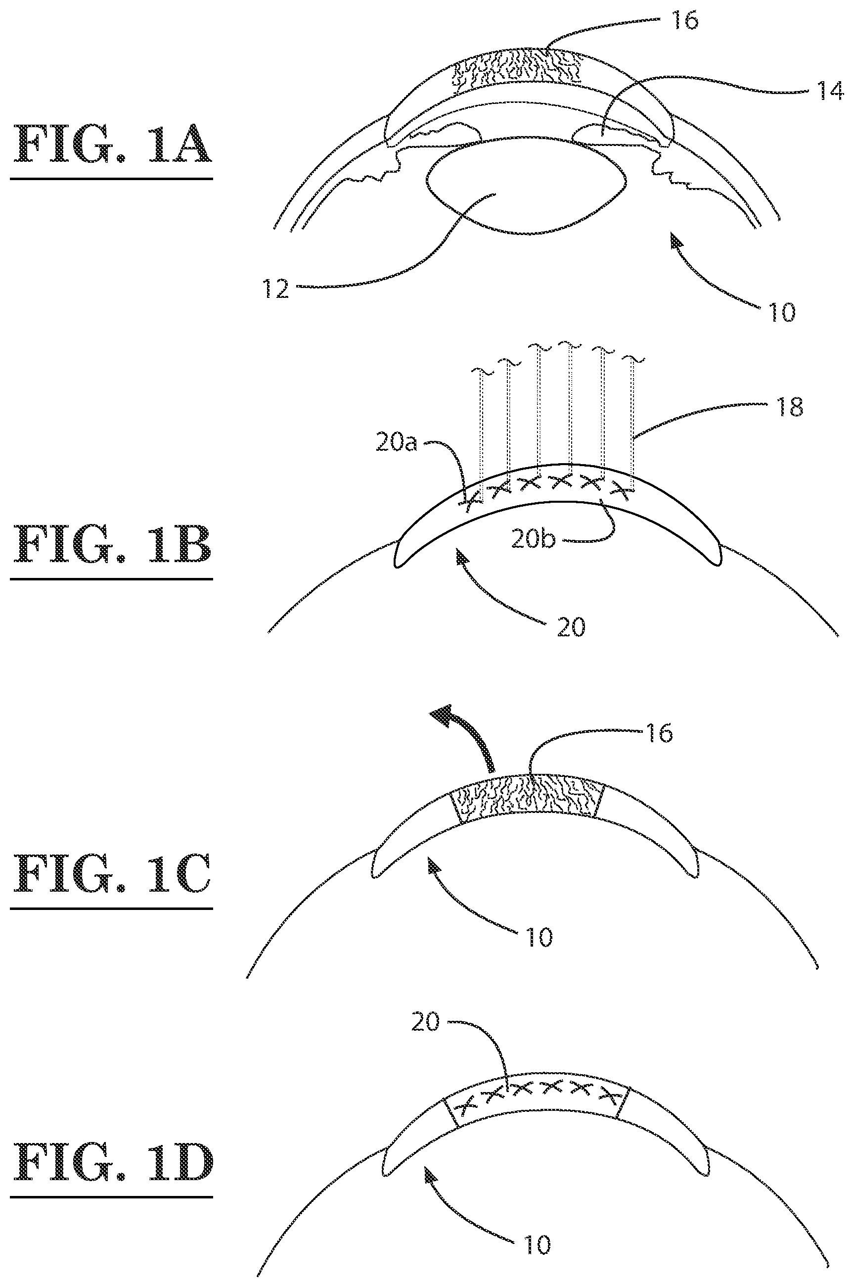 Patent US12396889 Figure 1 – Lamellar corneal autologous or homologous graft in refractive surgery