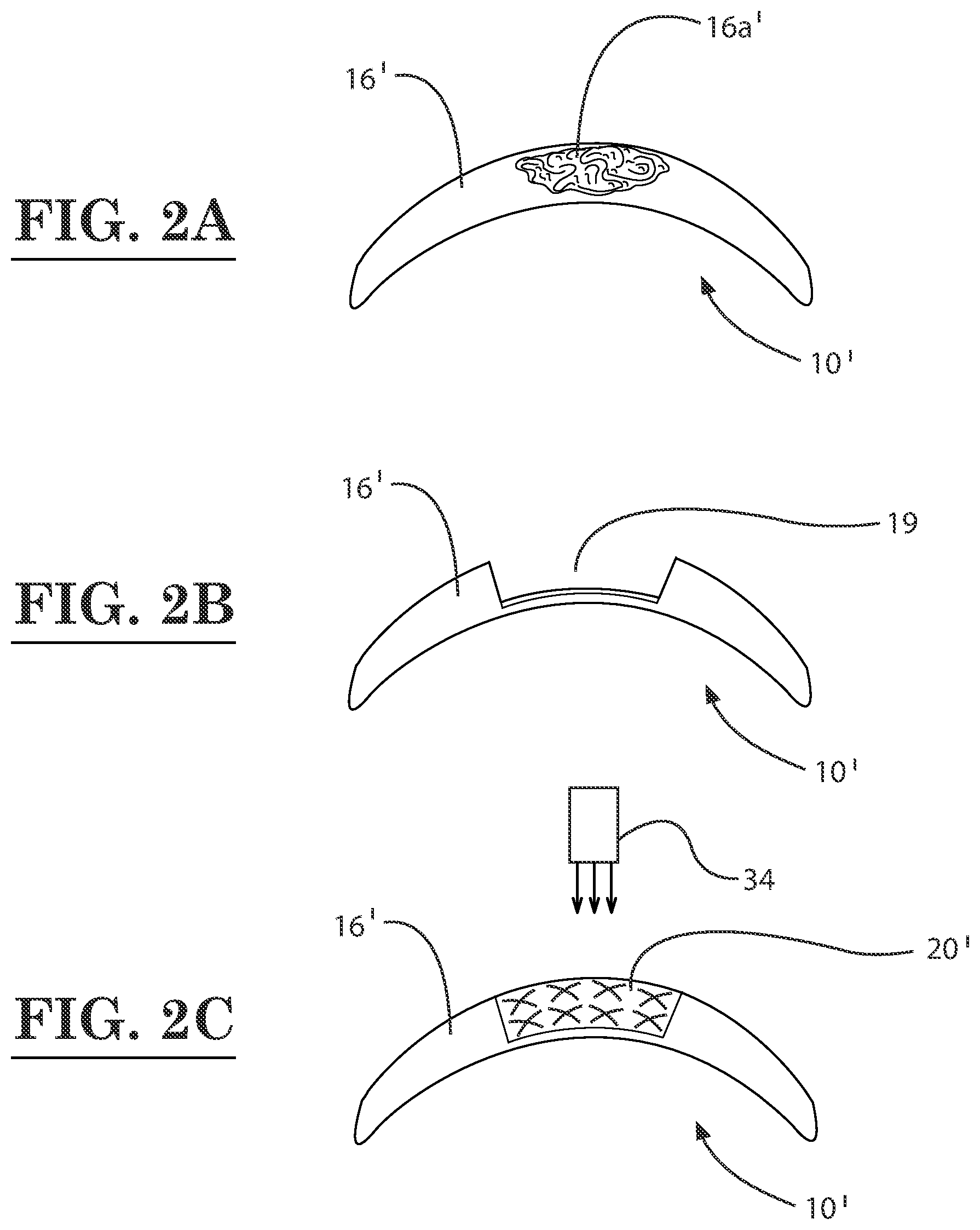 Patent US12396889 Figure 2 – Lamellar corneal autologous or homologous graft in refractive surgery