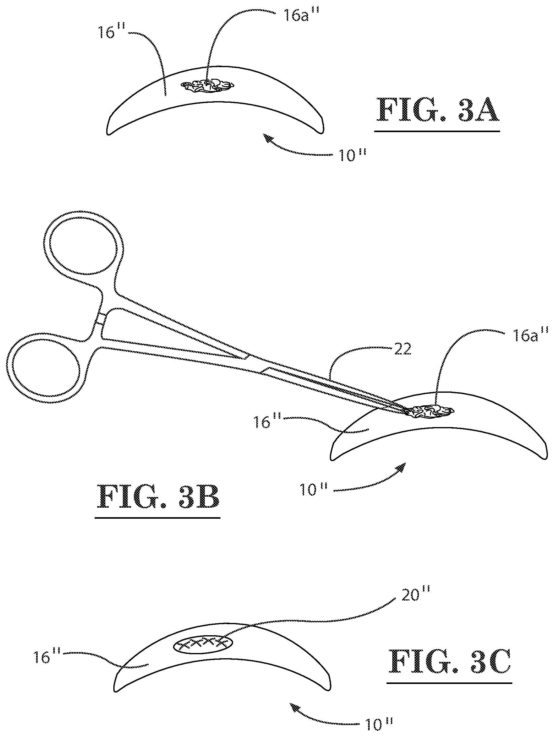 Patent US12396889 Figure 3 – Lamellar corneal autologous or homologous graft in refractive surgery
