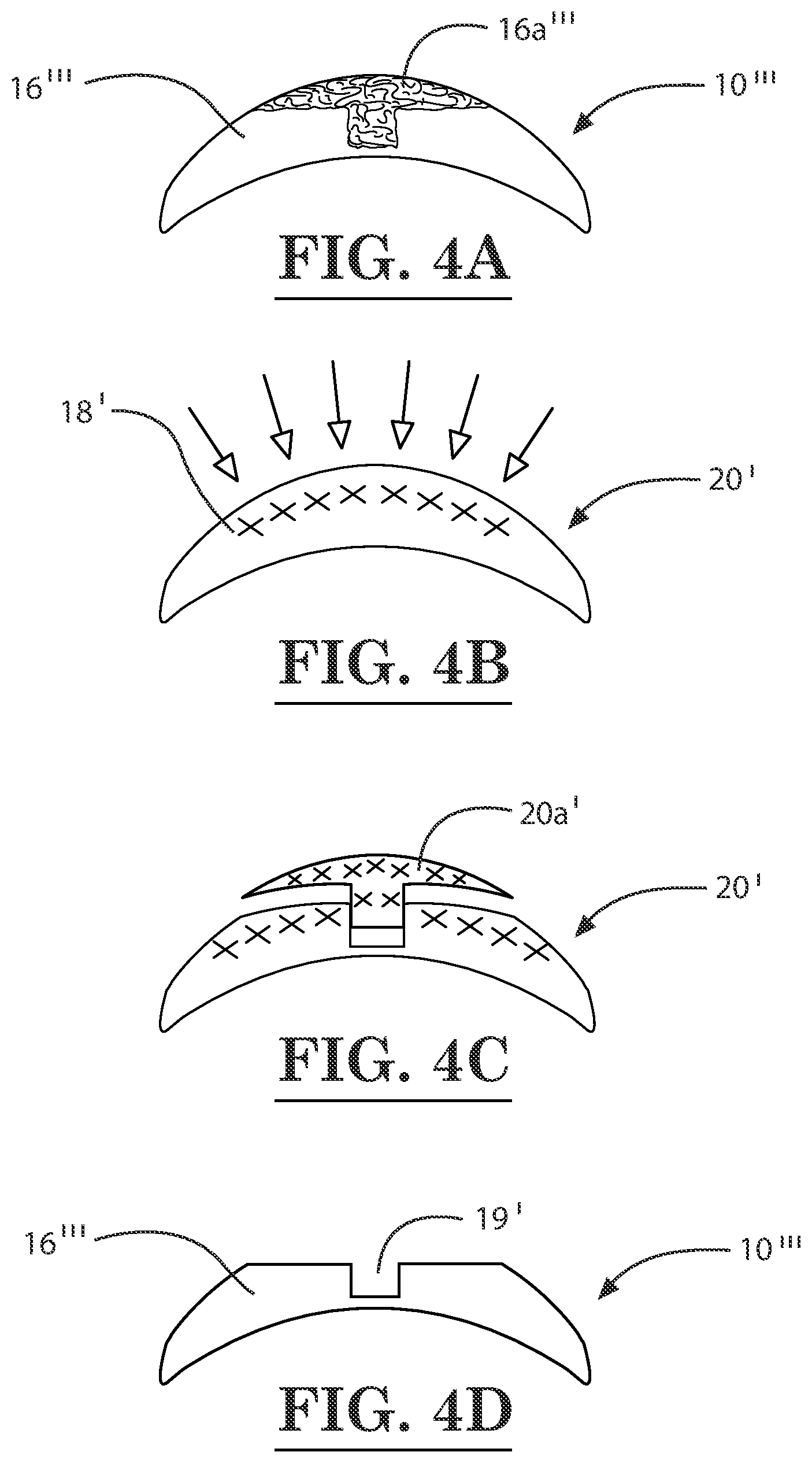 Patent US12396889 Figure 4 – Lamellar corneal autologous or homologous graft in refractive surgery