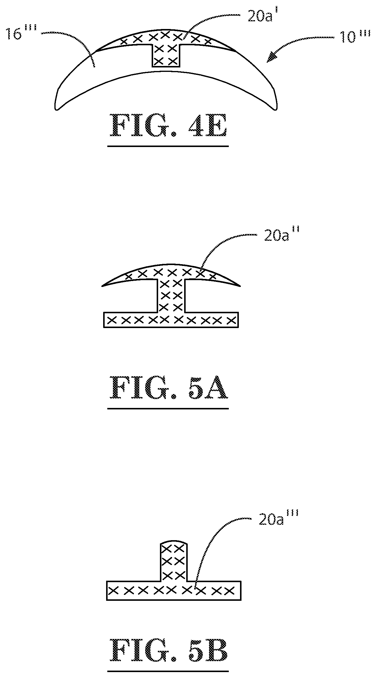 Patent US12396889 Figure 5 – Lamellar corneal autologous or homologous graft in refractive surgery