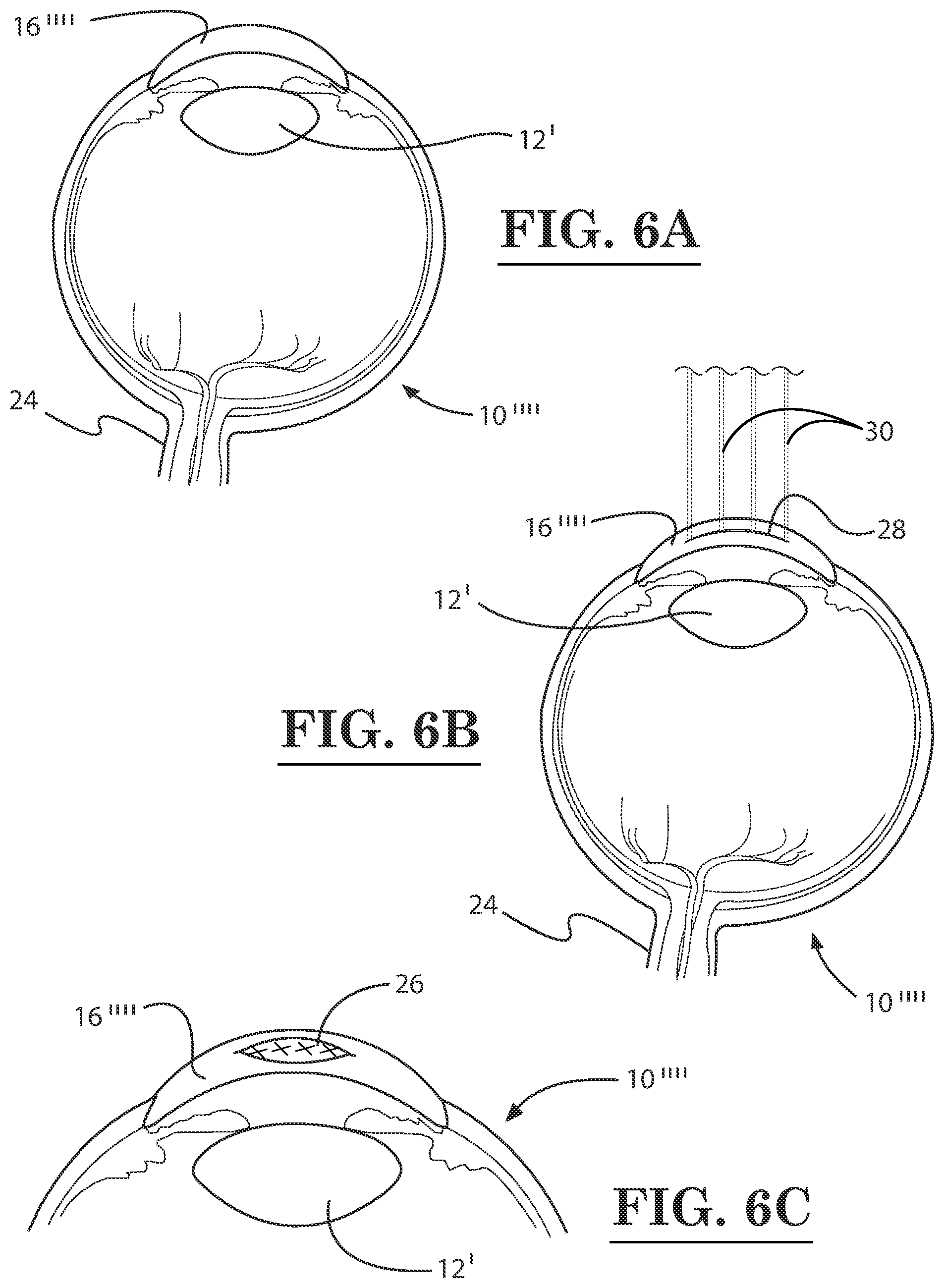 Patent US12396889 Figure 6 – Lamellar corneal autologous or homologous graft in refractive surgery