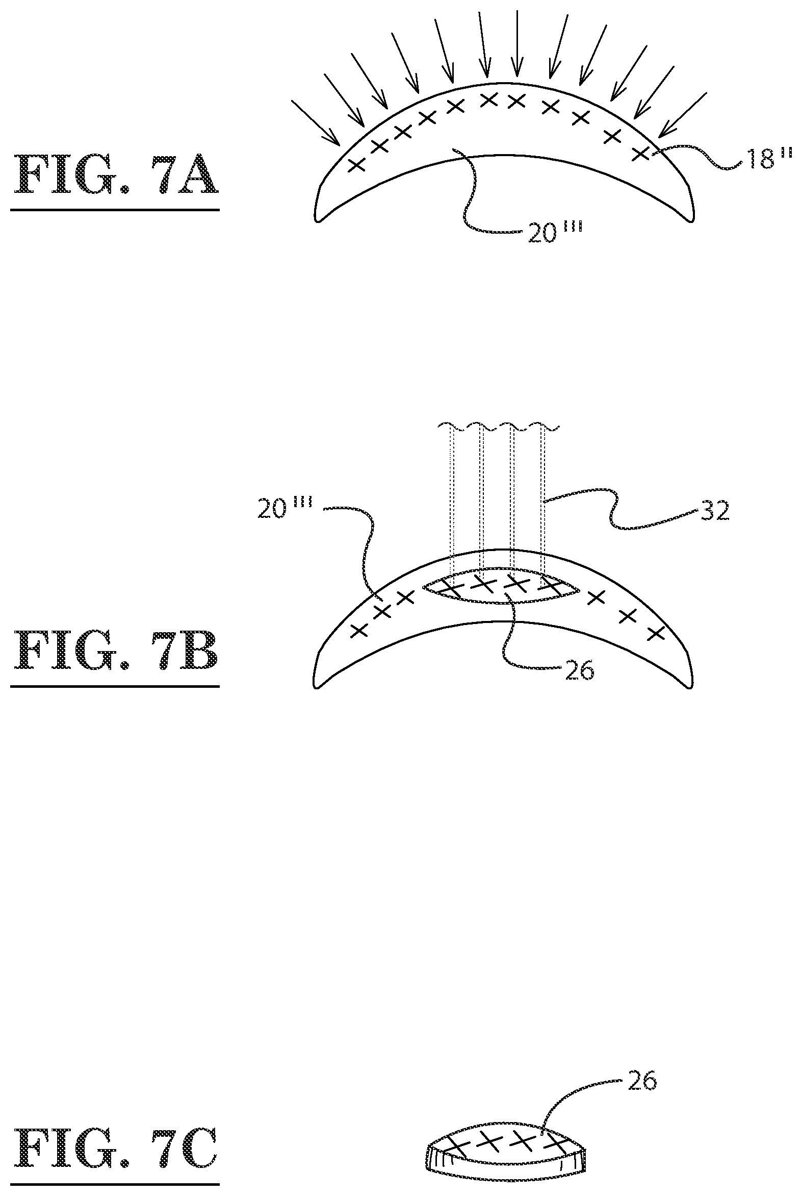 Patent US12396889 Figure 7 – Lamellar corneal autologous or homologous graft in refractive surgery