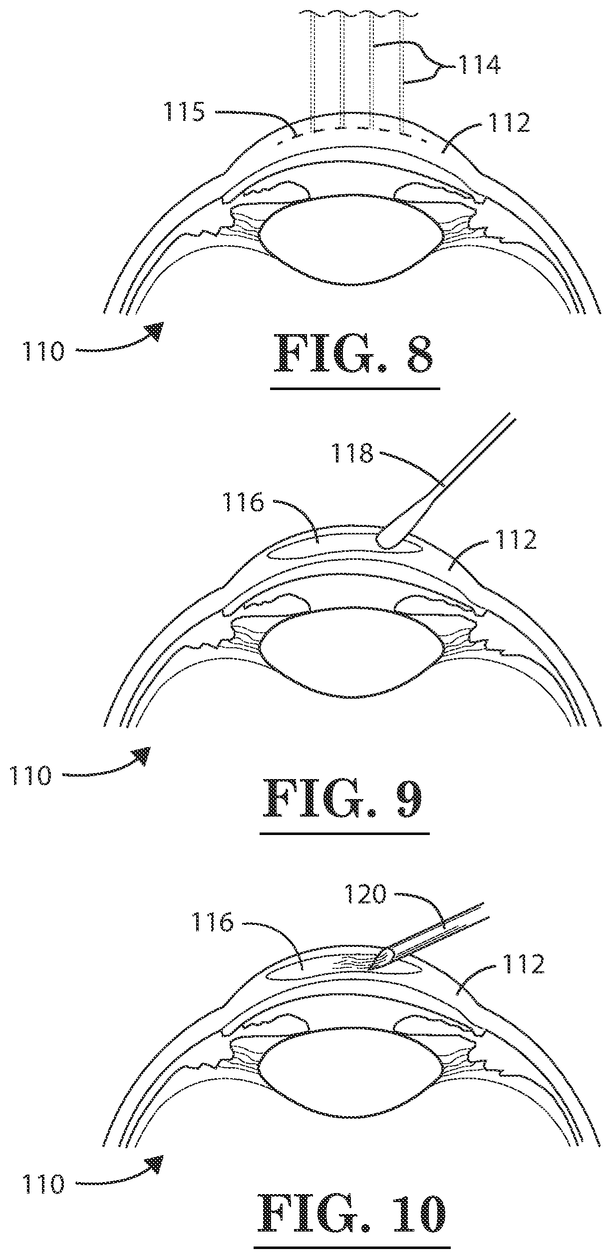 Patent US12396889 Figure 8 – Lamellar corneal autologous or homologous graft in refractive surgery