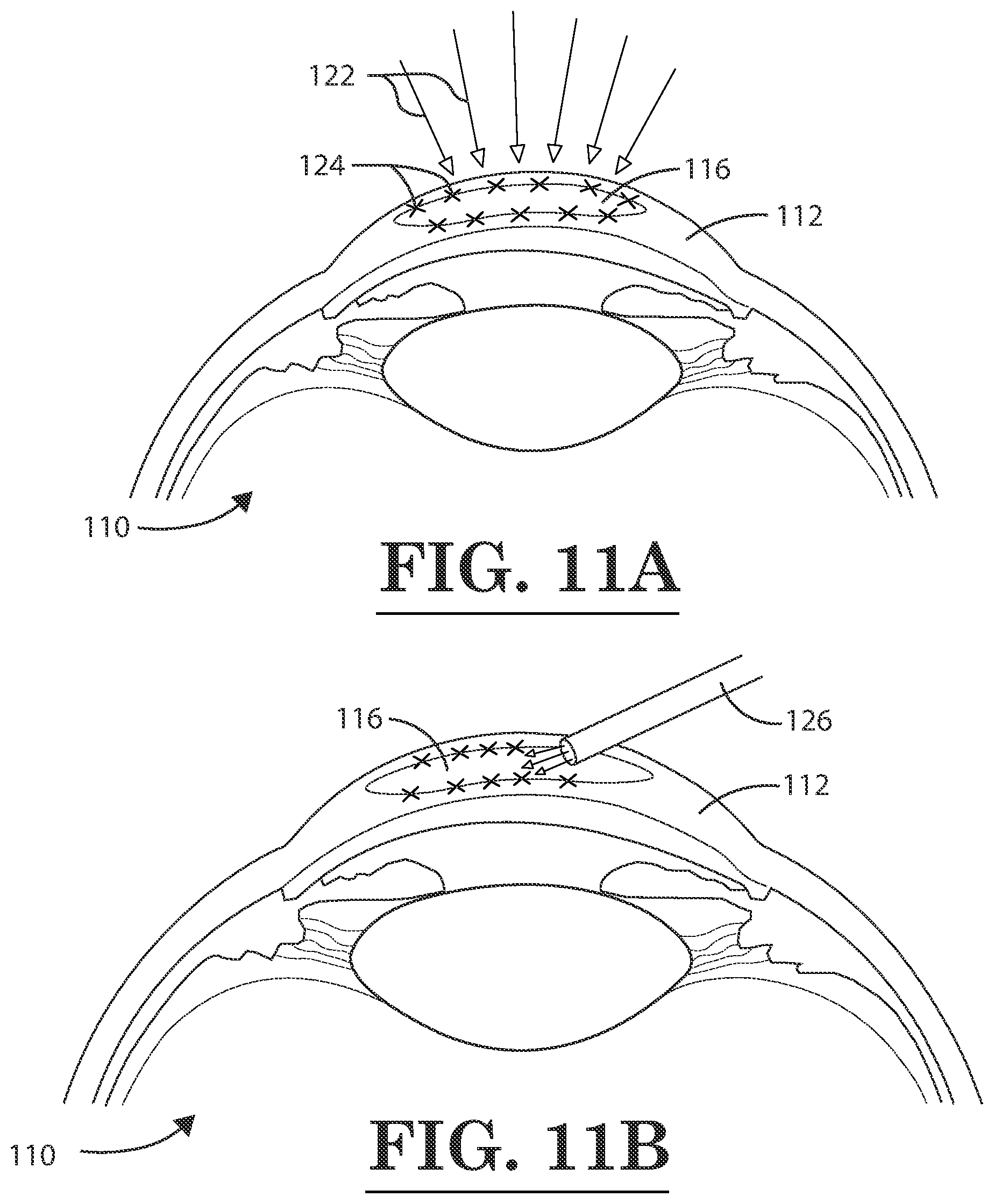 Patent US12396889 Figure 9 – Lamellar corneal autologous or homologous graft in refractive surgery