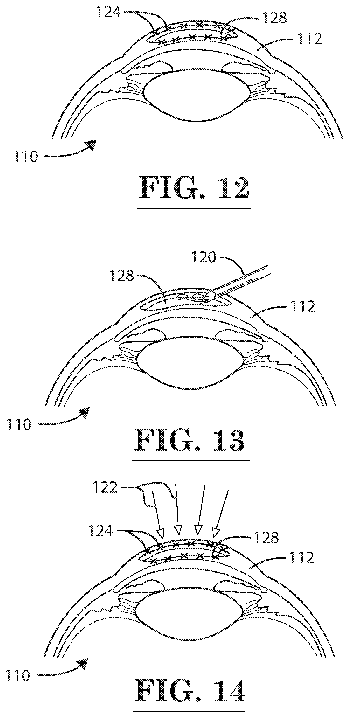 Patent US12396889 Figure 10 – Lamellar corneal autologous or homologous graft in refractive surgery