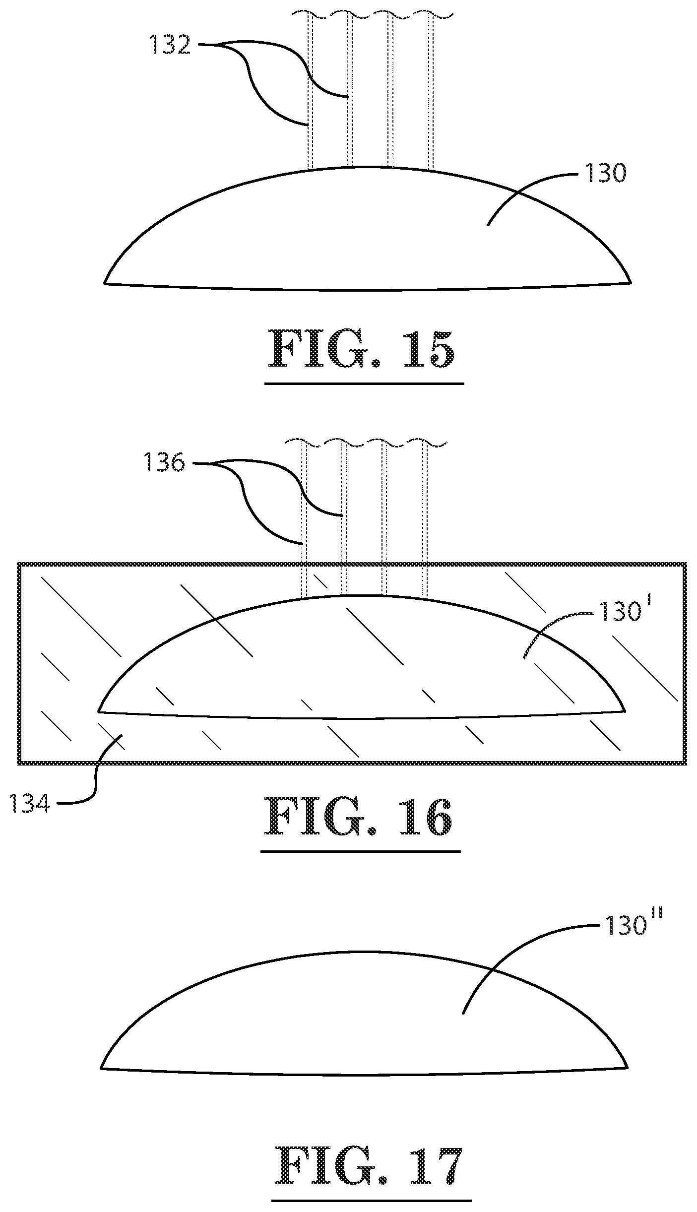 Patent US12396889 Figure 11 – Lamellar corneal autologous or homologous graft in refractive surgery