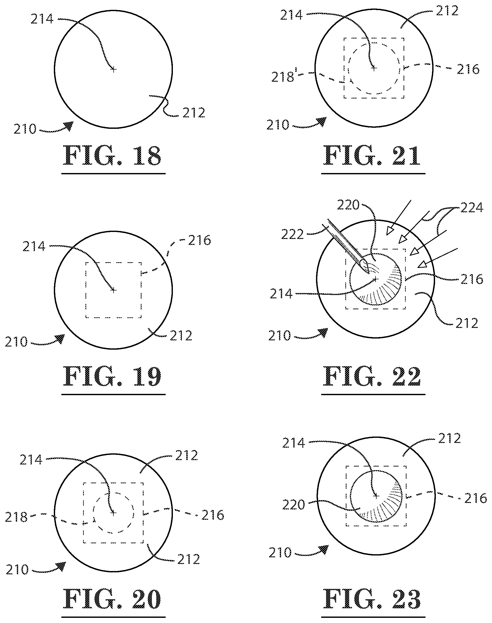 Patent US12396889 Figure 12 – Lamellar corneal autologous or homologous graft in refractive surgery