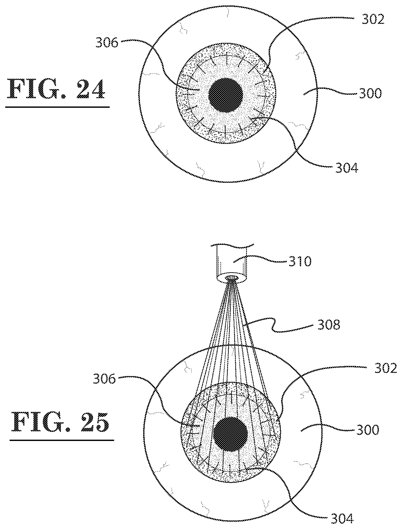 Patent US12396889 Figure 13 – Lamellar corneal autologous or homologous graft in refractive surgery