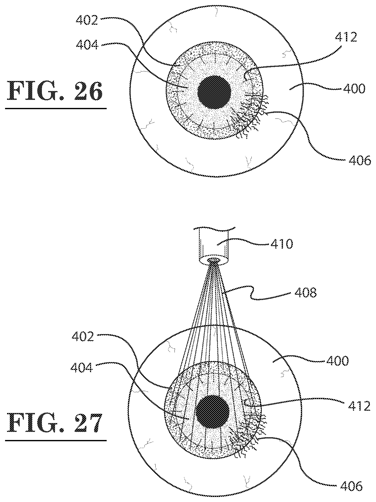 Patent US12396889 Figure 14 – Lamellar corneal autologous or homologous graft in refractive surgery