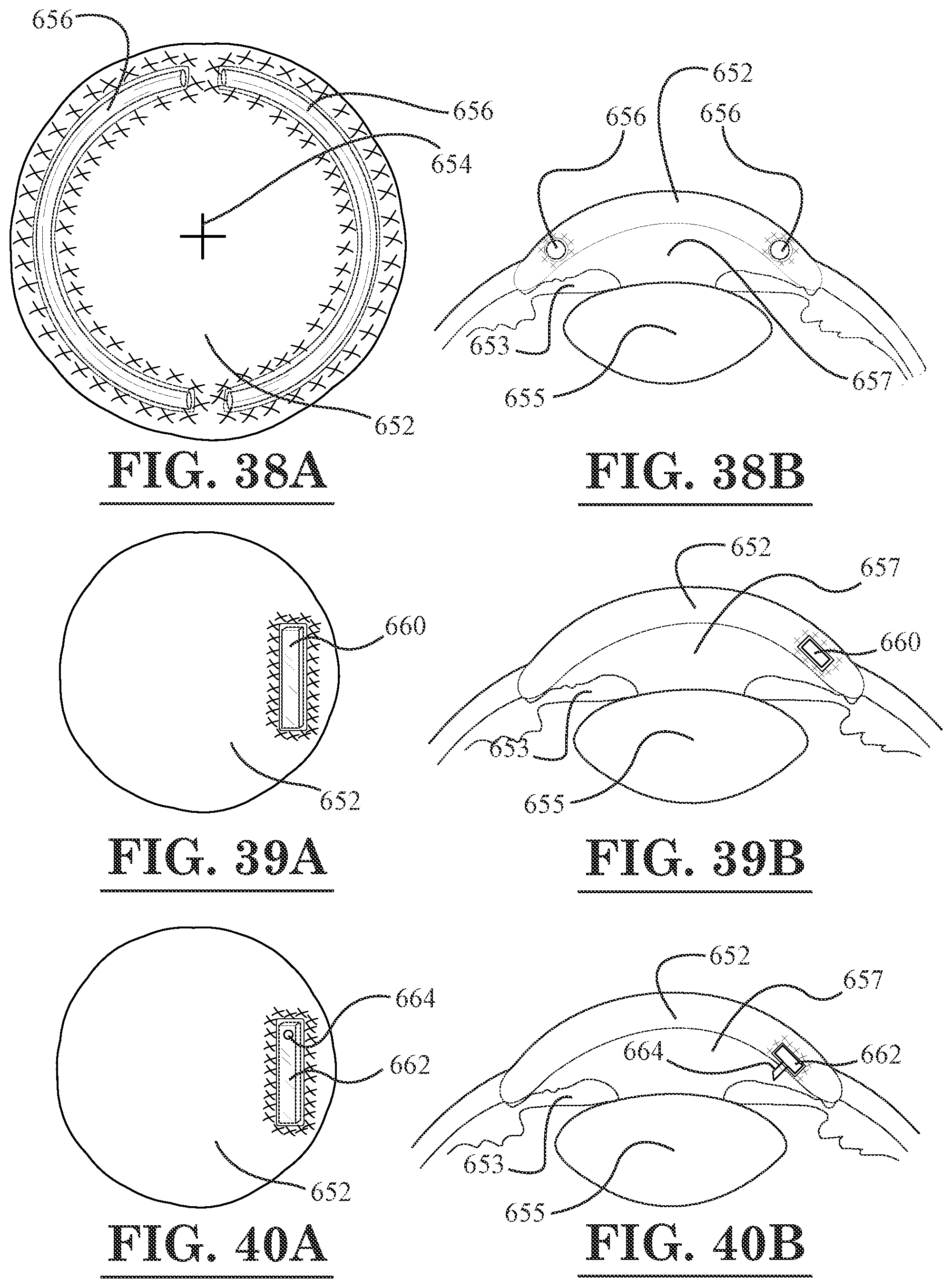 Patent US12396889 Figure 19 – Lamellar corneal autologous or homologous graft in refractive surgery