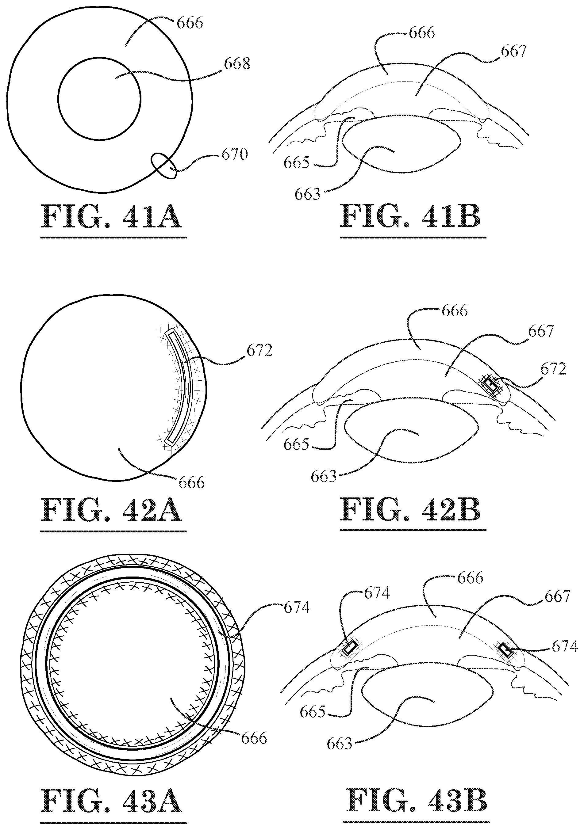 Patent US12396889 Figure 20 – Lamellar corneal autologous or homologous graft in refractive surgery