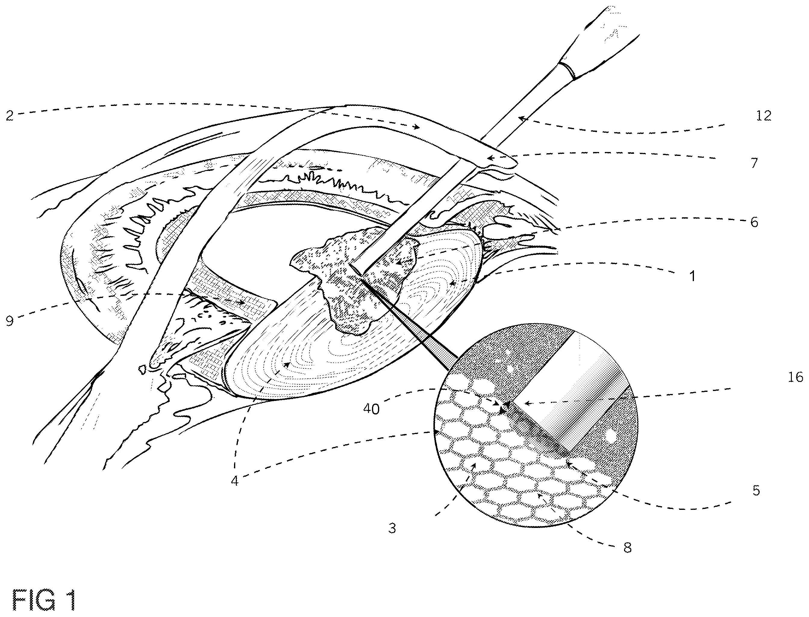 Patent US12396891 Figure 1 – Laser apparatus for treatment of a cataractous lens