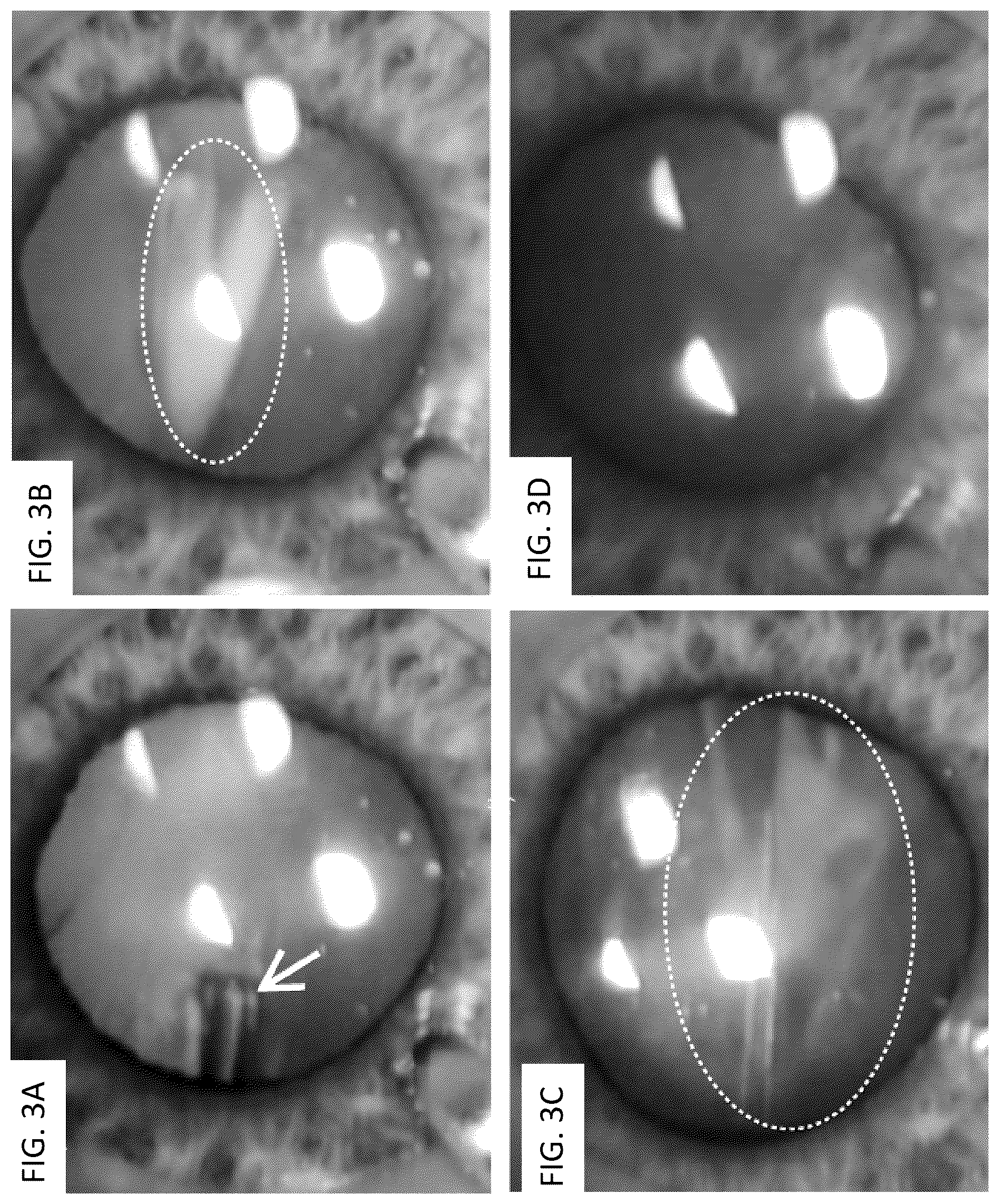 Patent US12396891 Figure 3 – Laser apparatus for treatment of a cataractous lens