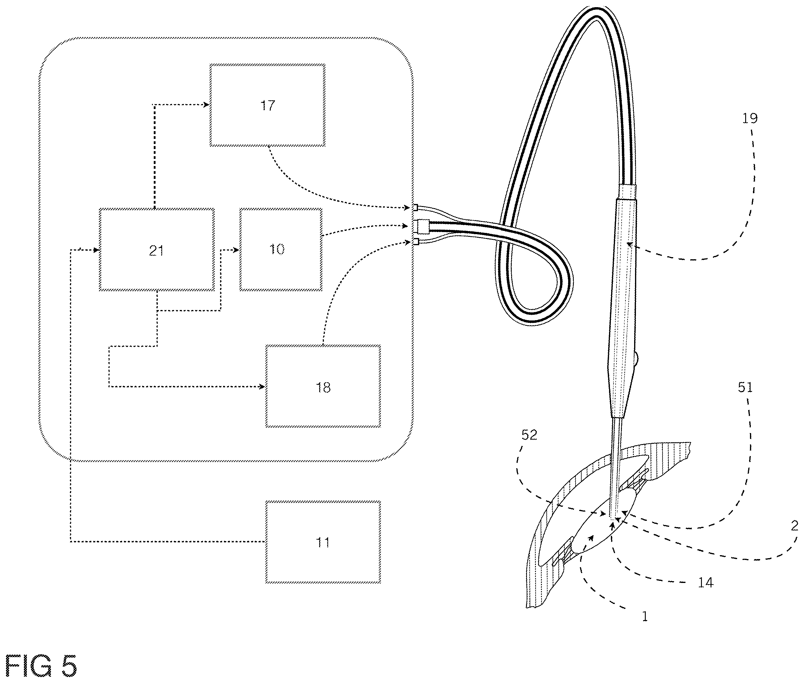Patent US12396891 Figure 5 – Laser apparatus for treatment of a cataractous lens