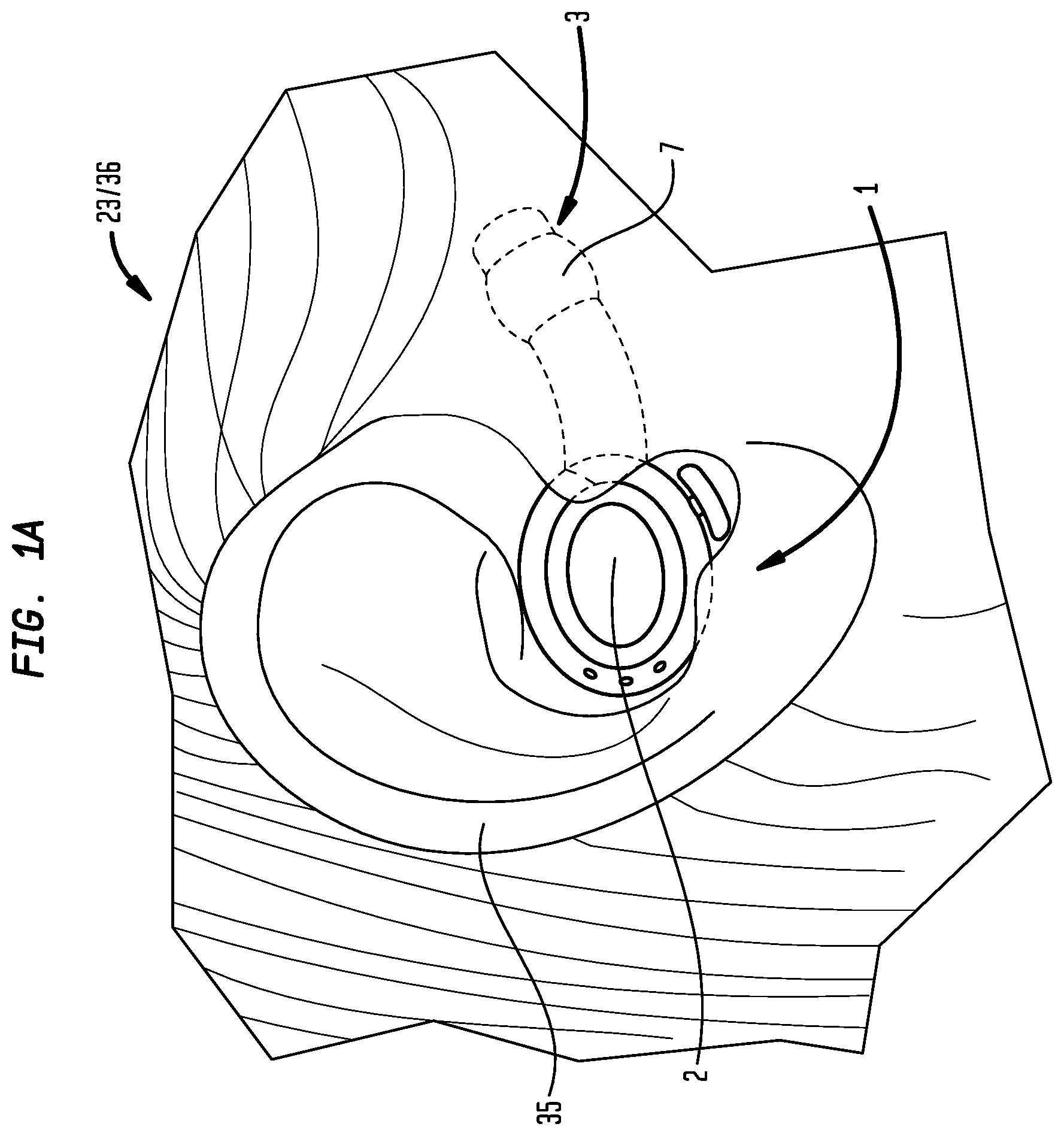 Patent US12396892 Figure 1 – External ear canal pressure regulation device