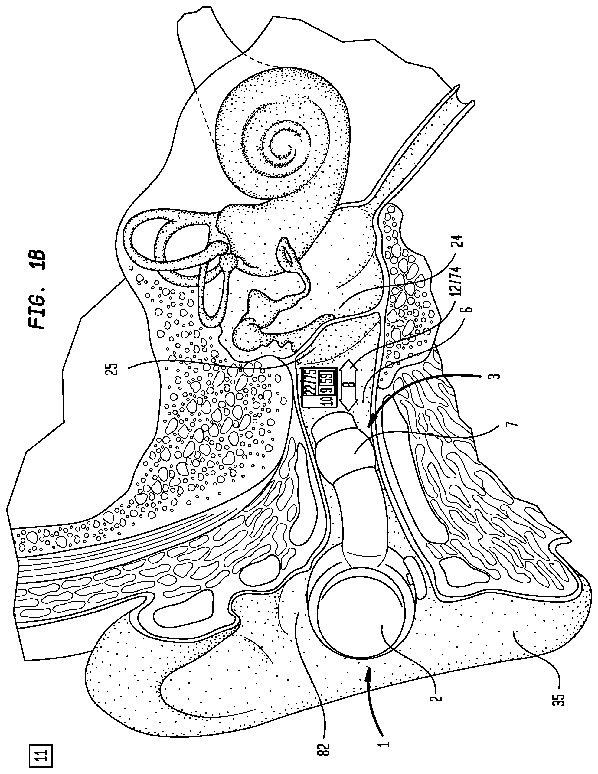 Patent US12396892 Figure 2 – External ear canal pressure regulation device