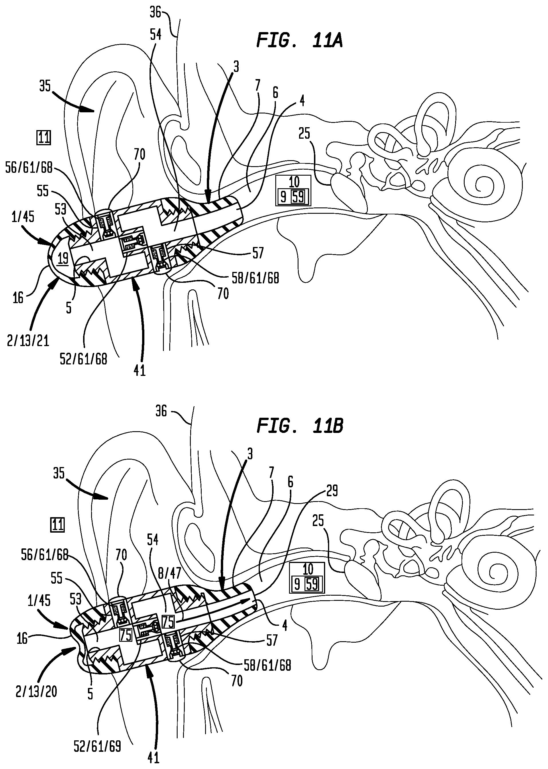Patent US12396892 Figure 9 – External ear canal pressure regulation device