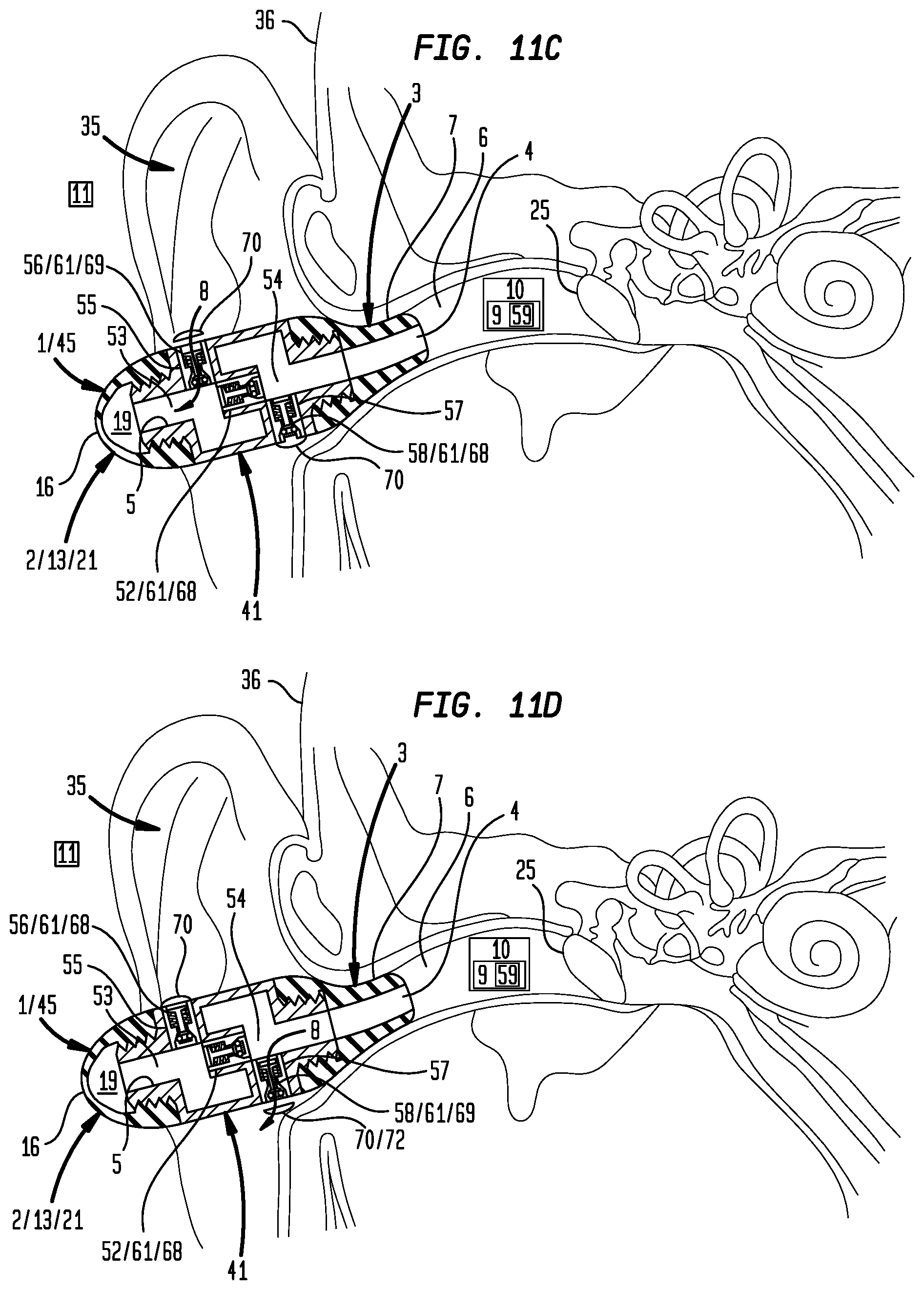 Patent US12396892 Figure 10 – External ear canal pressure regulation device