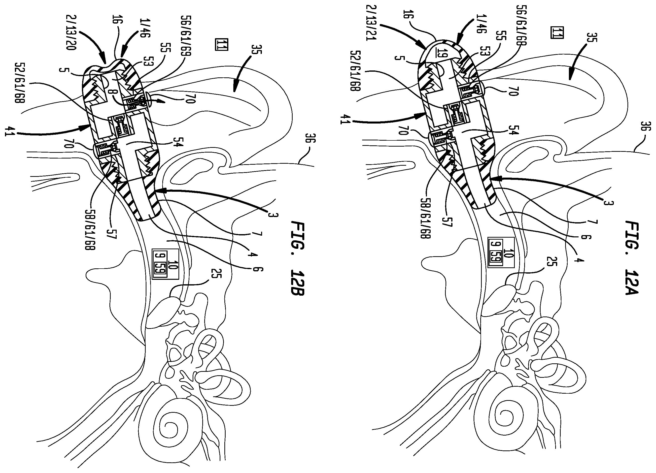 Patent US12396892 Figure 11 – External ear canal pressure regulation device
