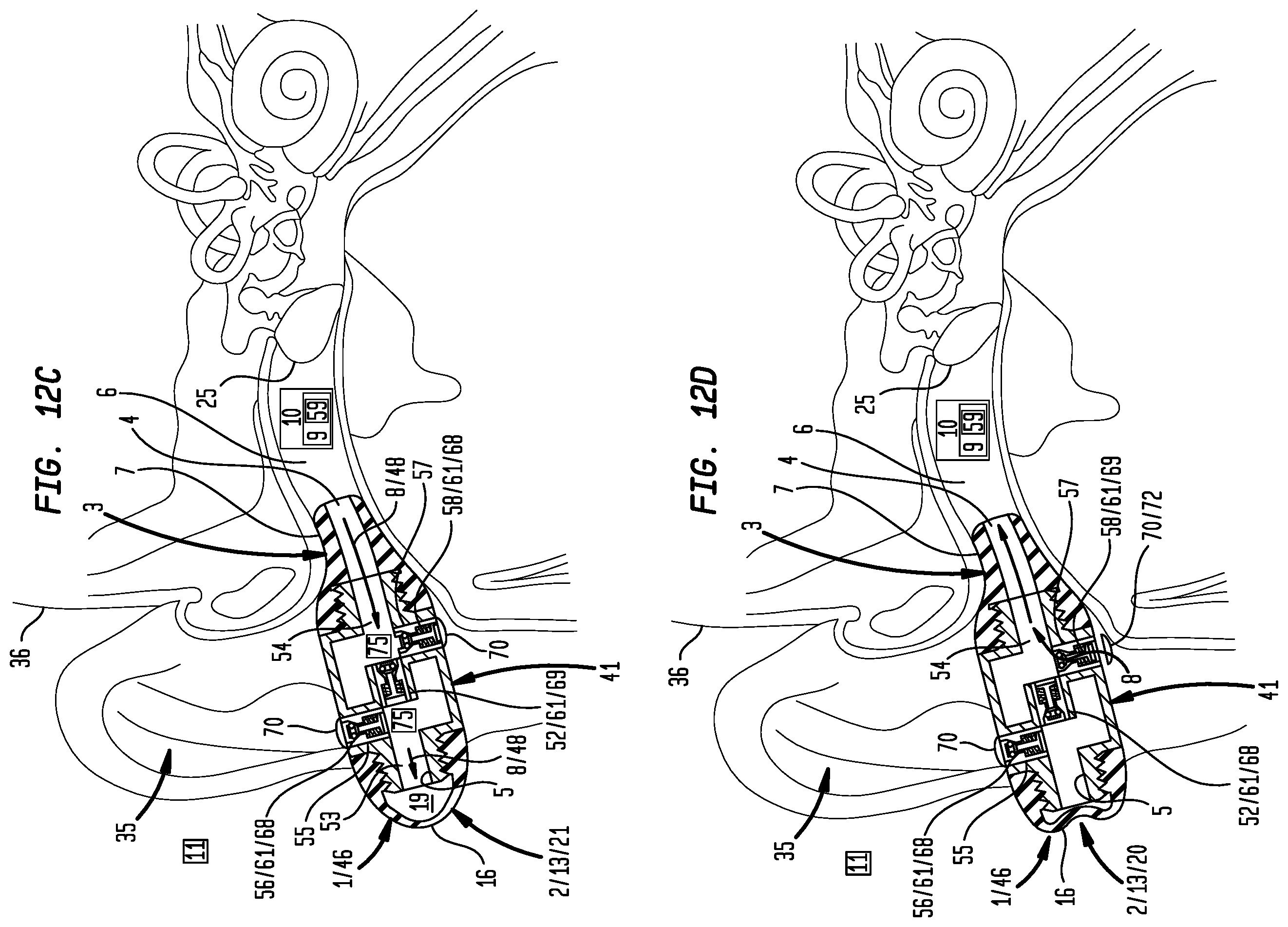Patent US12396892 Figure 12 – External ear canal pressure regulation device