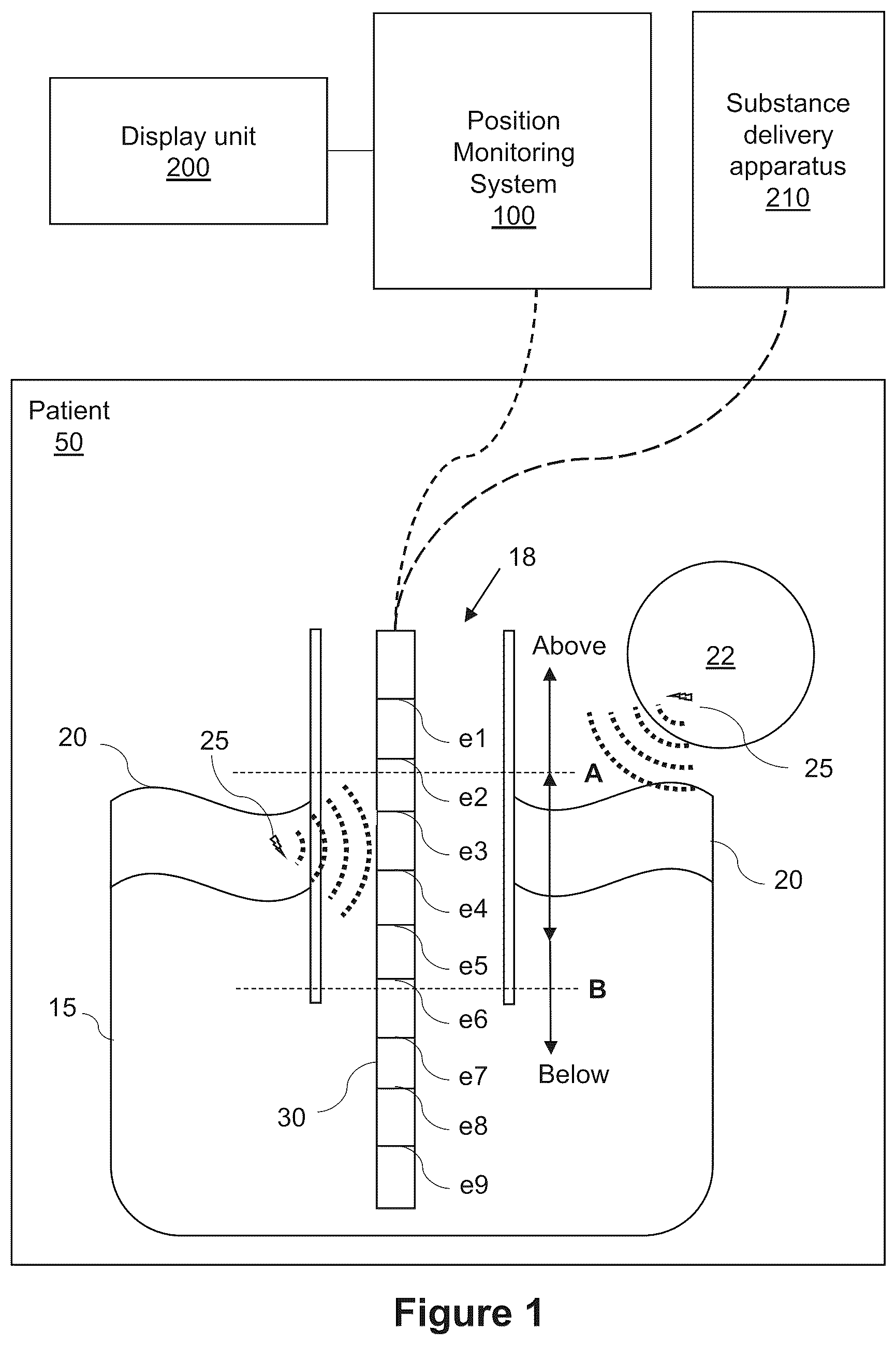 Patent US12396927 Figure 1 – Classifying of a position of a catheter in relation to a diaphragm