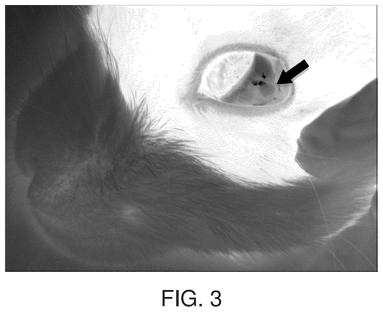 Patent US12396959 Figure 2 – Thermoresponsive hydrogel containing polymer microparticles for noninvasive ocular drug delivery