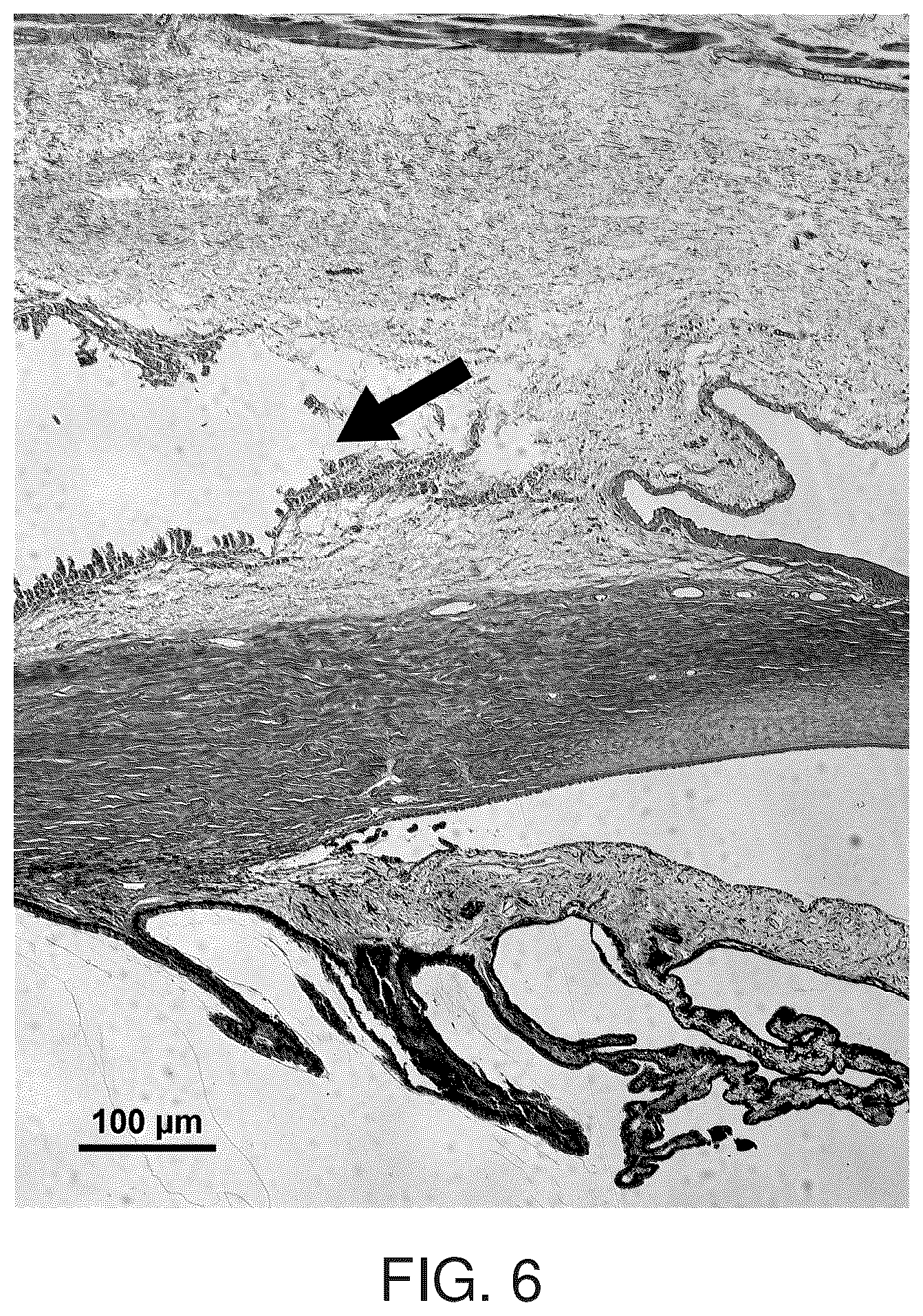 Patent US12396959 Figure 5 – Thermoresponsive hydrogel containing polymer microparticles for noninvasive ocular drug delivery