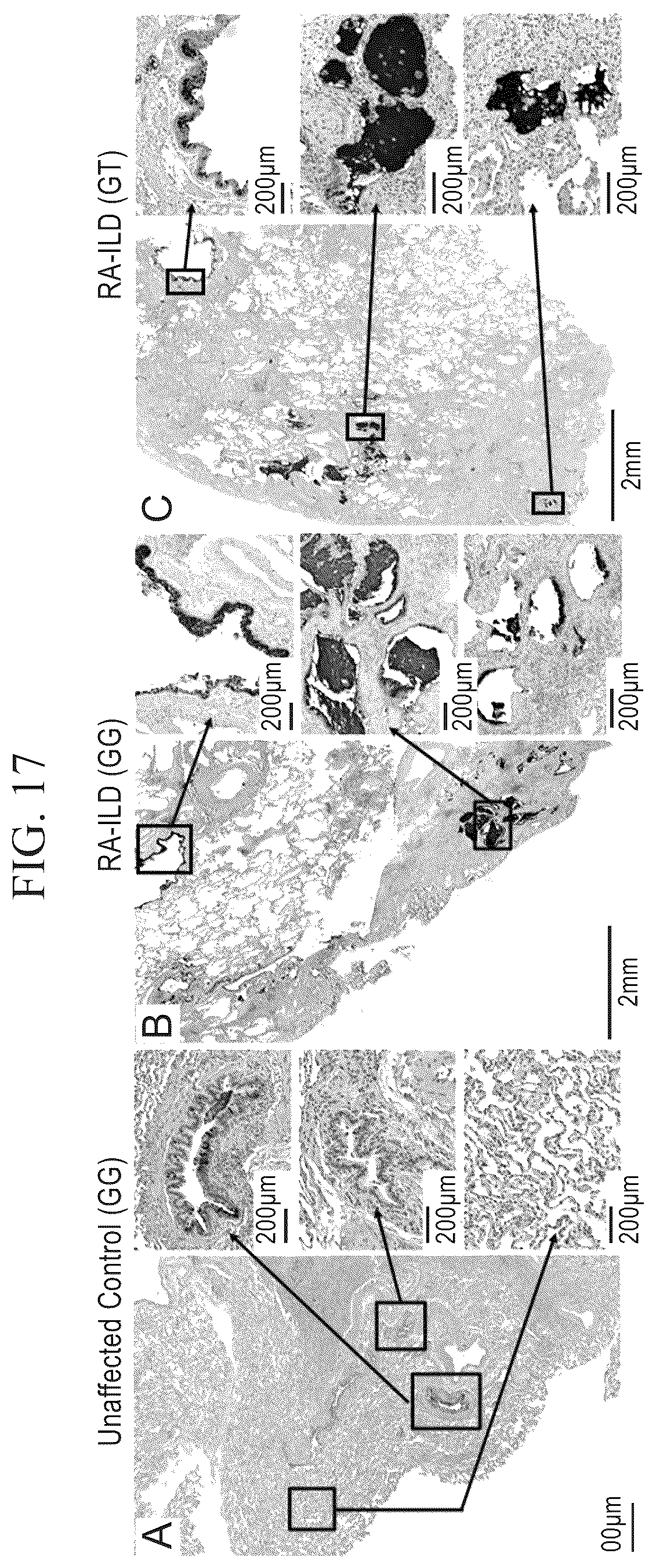 Patent US12396991 Figure 19 – Biomarkers for the diagnosis and treatment of fibrotic lung disease
