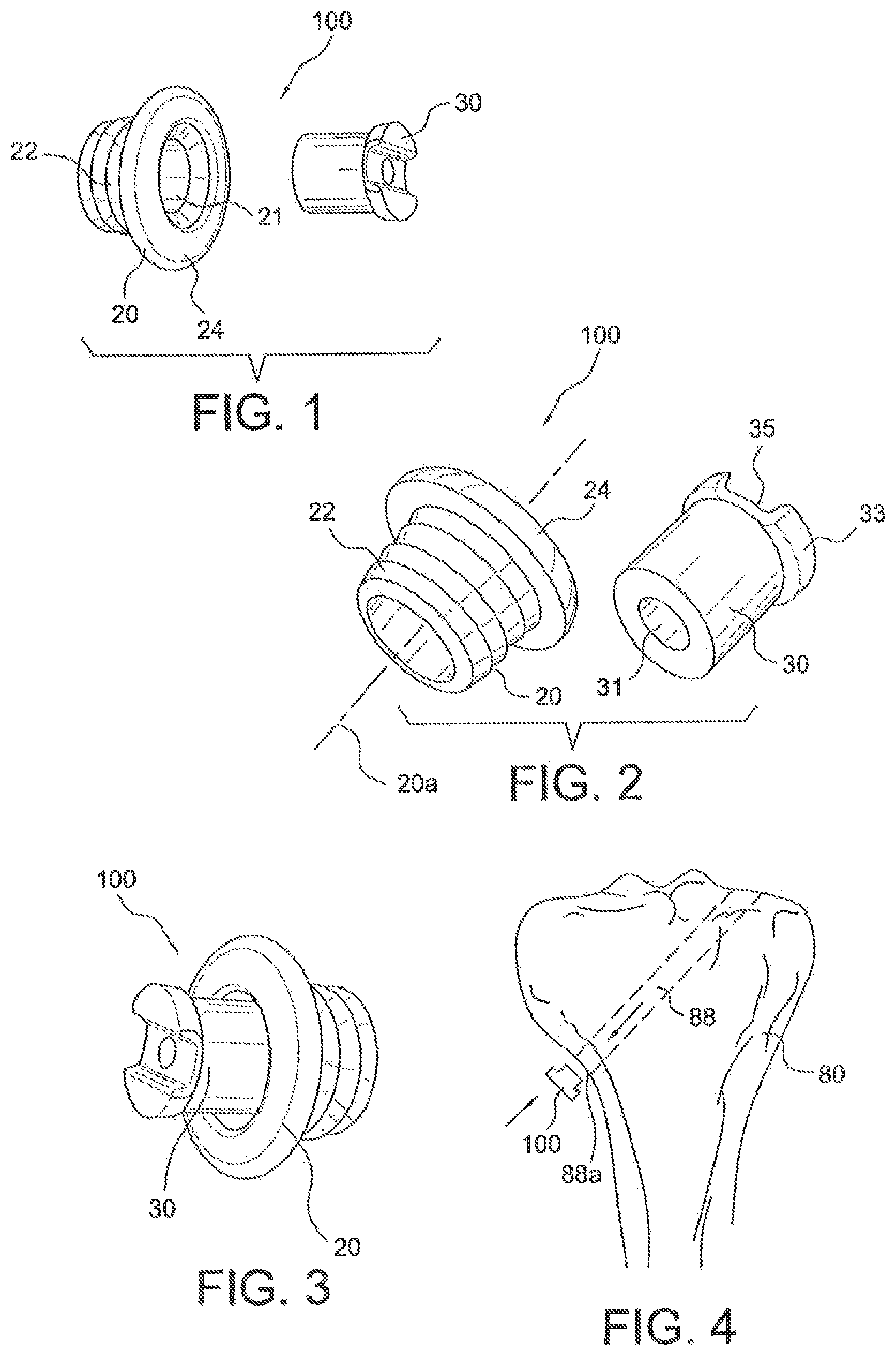 Patent US12403000 Figure 1 – Ligament fixation device and method