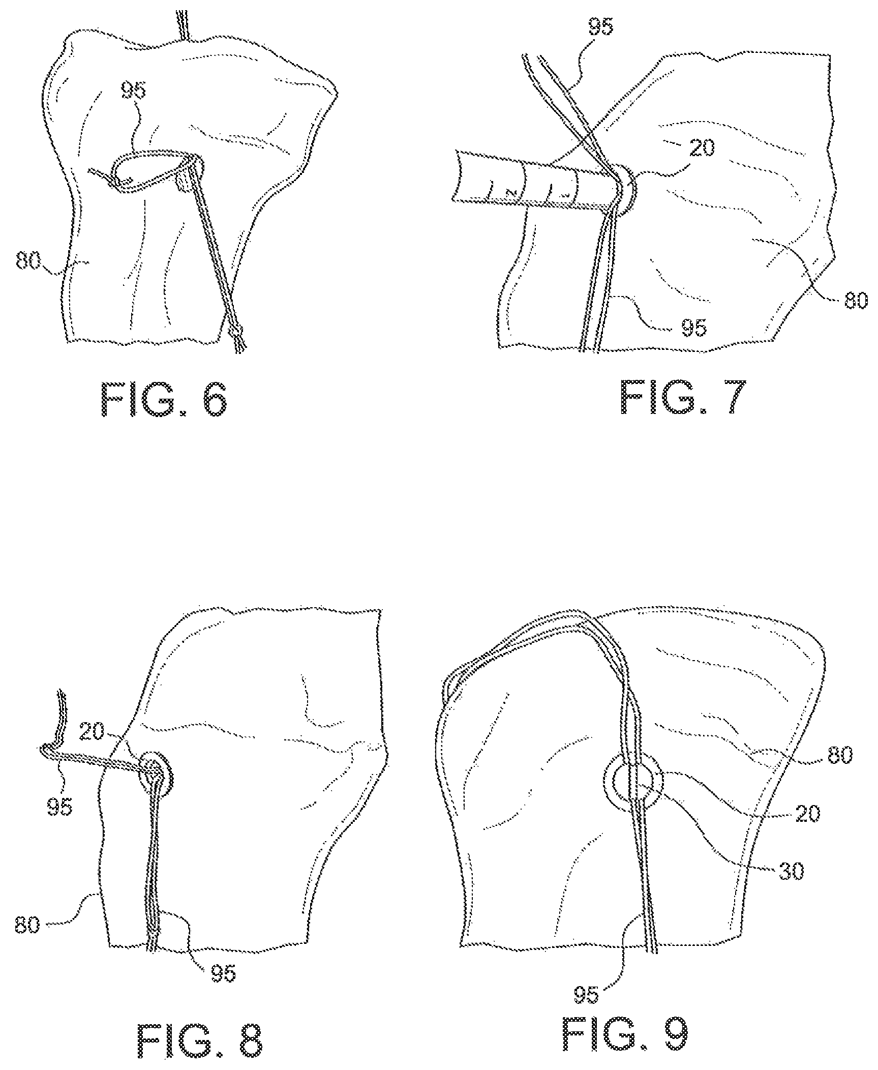 Patent US12403000 Figure 3 – Ligament fixation device and method