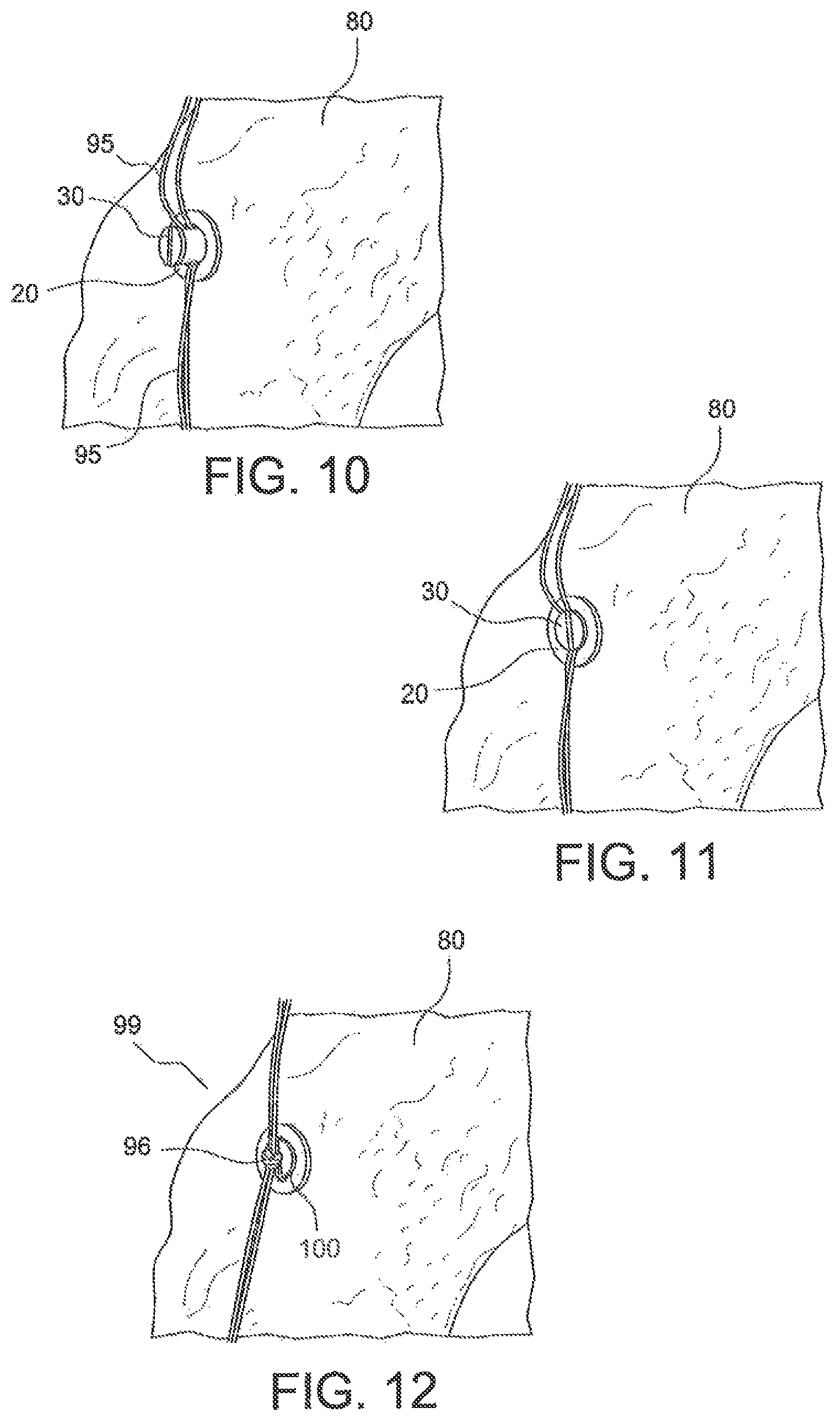 Patent US12403000 Figure 4 – Ligament fixation device and method