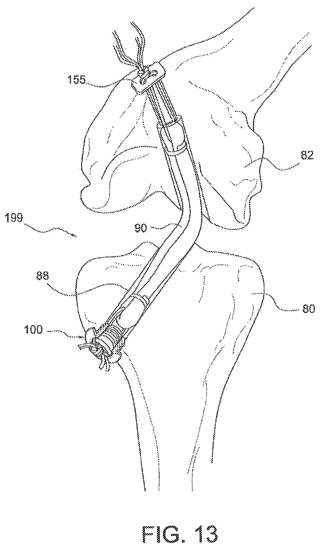 Patent US12403000 Figure 5 – Ligament fixation device and method