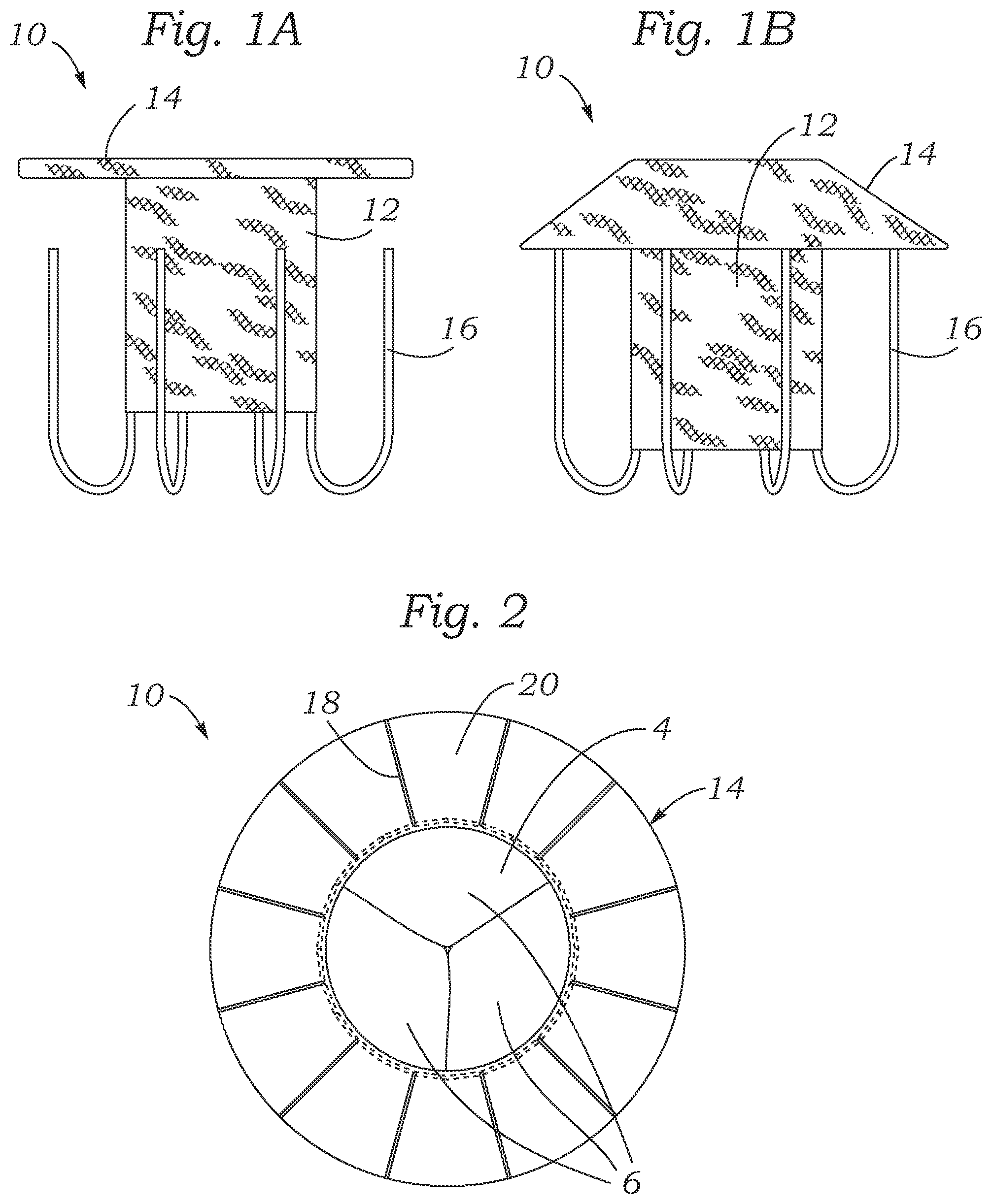 Patent US12403004 Figure 1 – Method for replacing a tricuspid valve